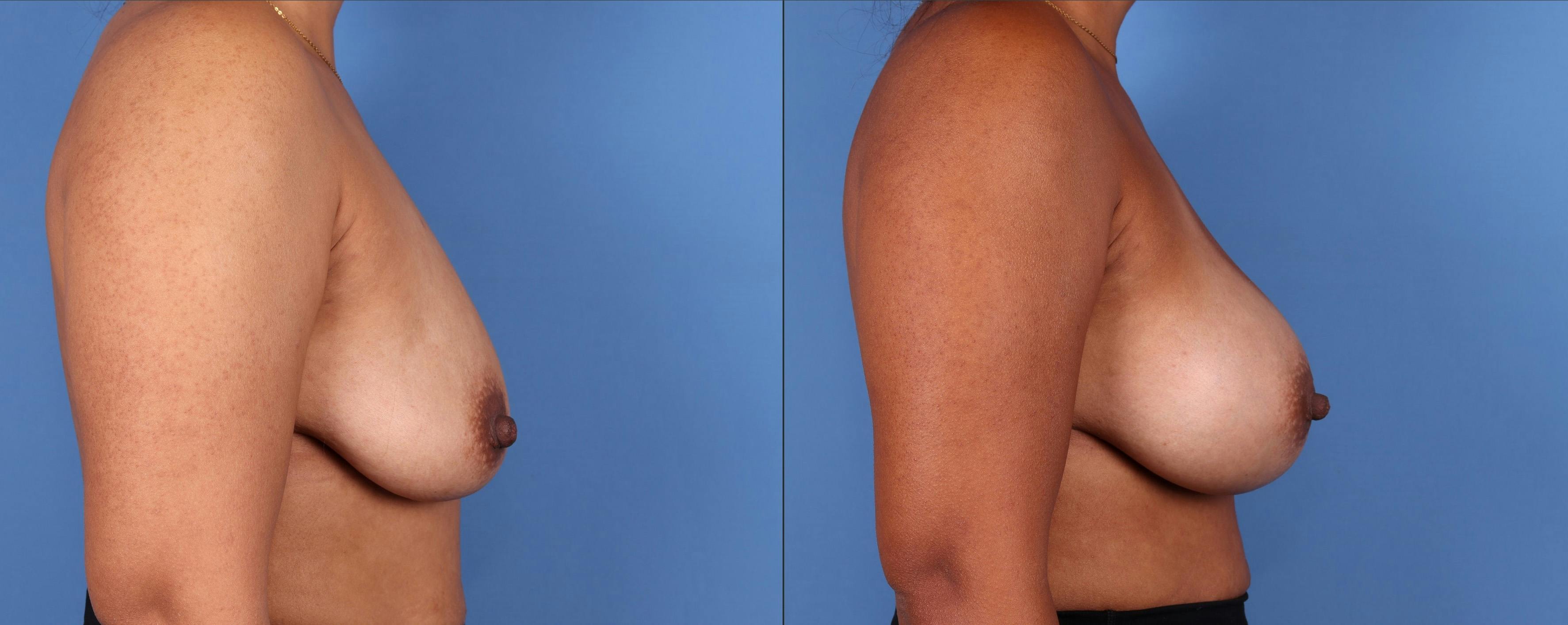 Breast Augmentation Before & After Gallery - Patient 123000303 - Image 5