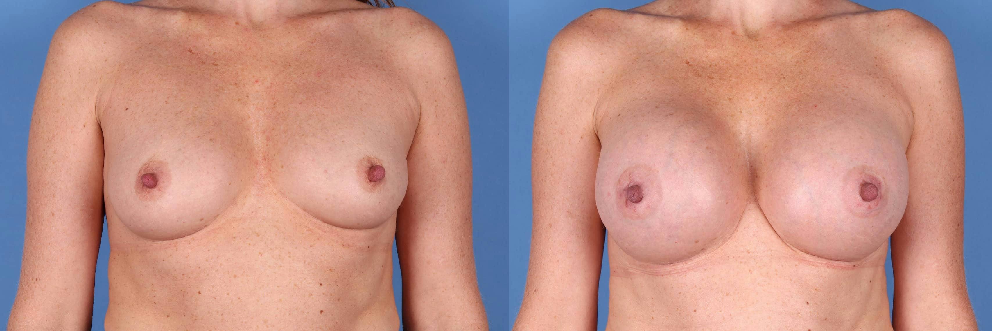 Breast Augmentation Before & After Gallery - Patient 123065055 - Image 1