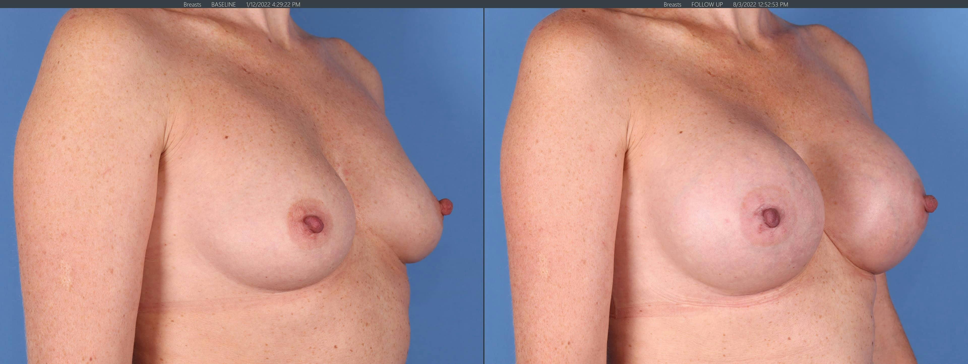 Breast Augmentation Before & After Gallery - Patient 123065055 - Image 2