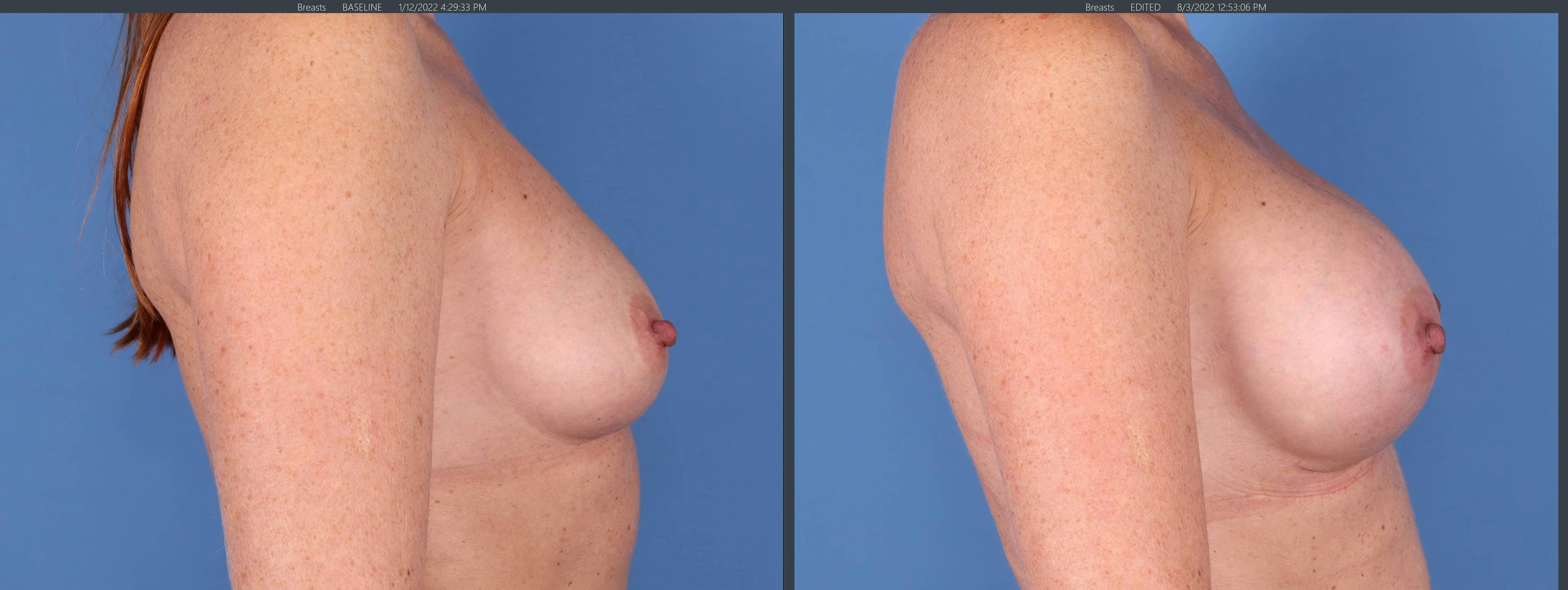 Breast Augmentation Before & After Gallery - Patient 123065055 - Image 3