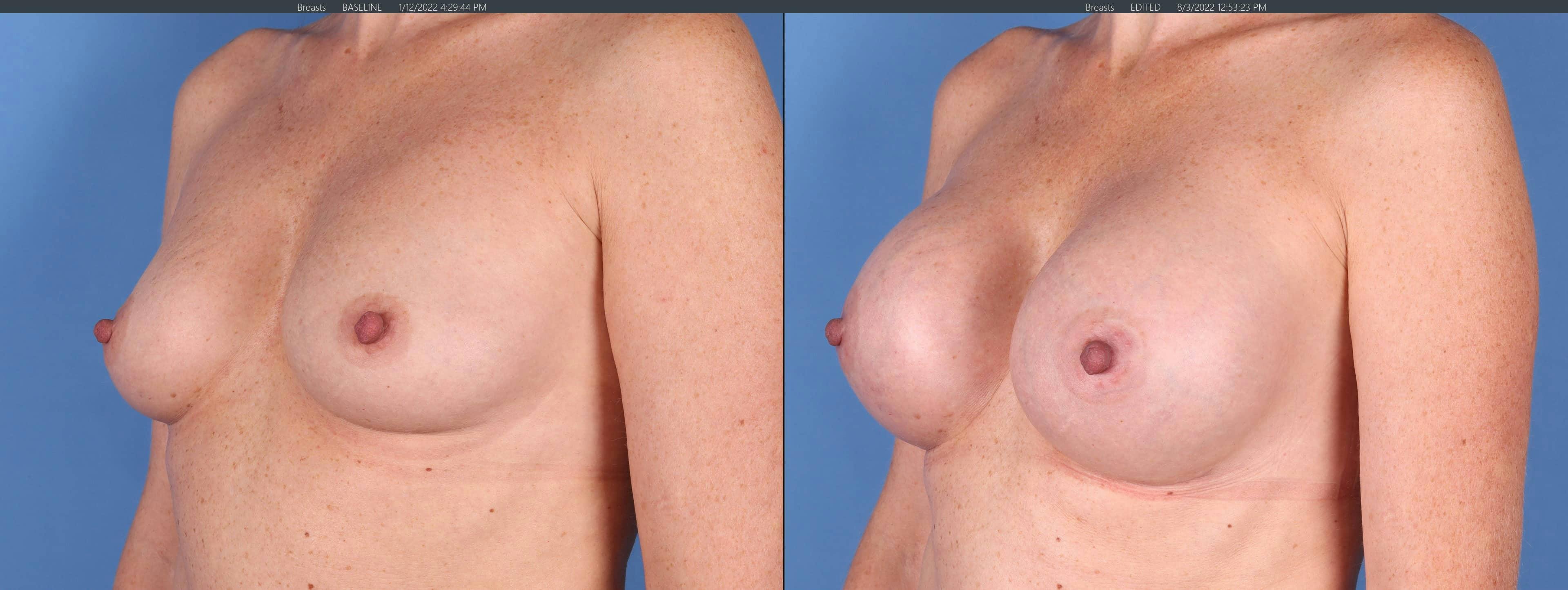 Breast Augmentation Gallery - Patient 123065055 - Image 4