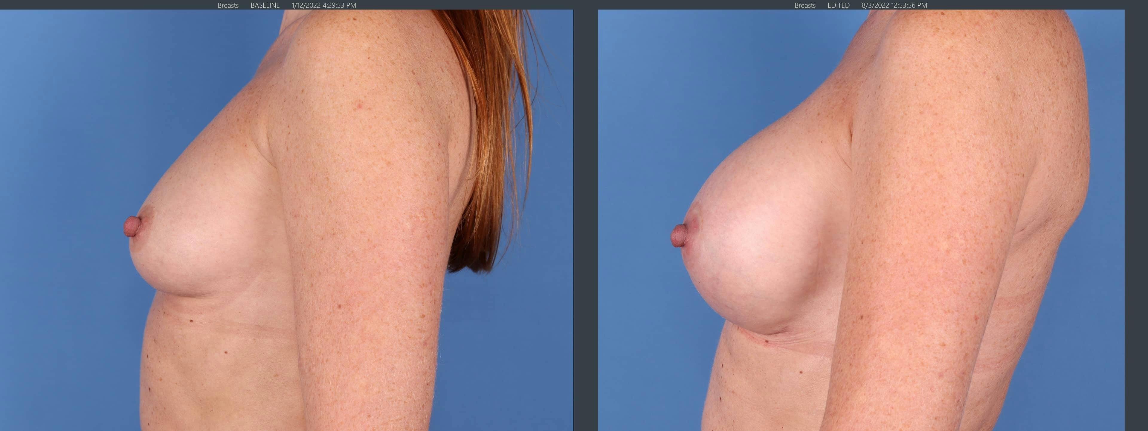 Breast Augmentation Gallery - Patient 123065055 - Image 5