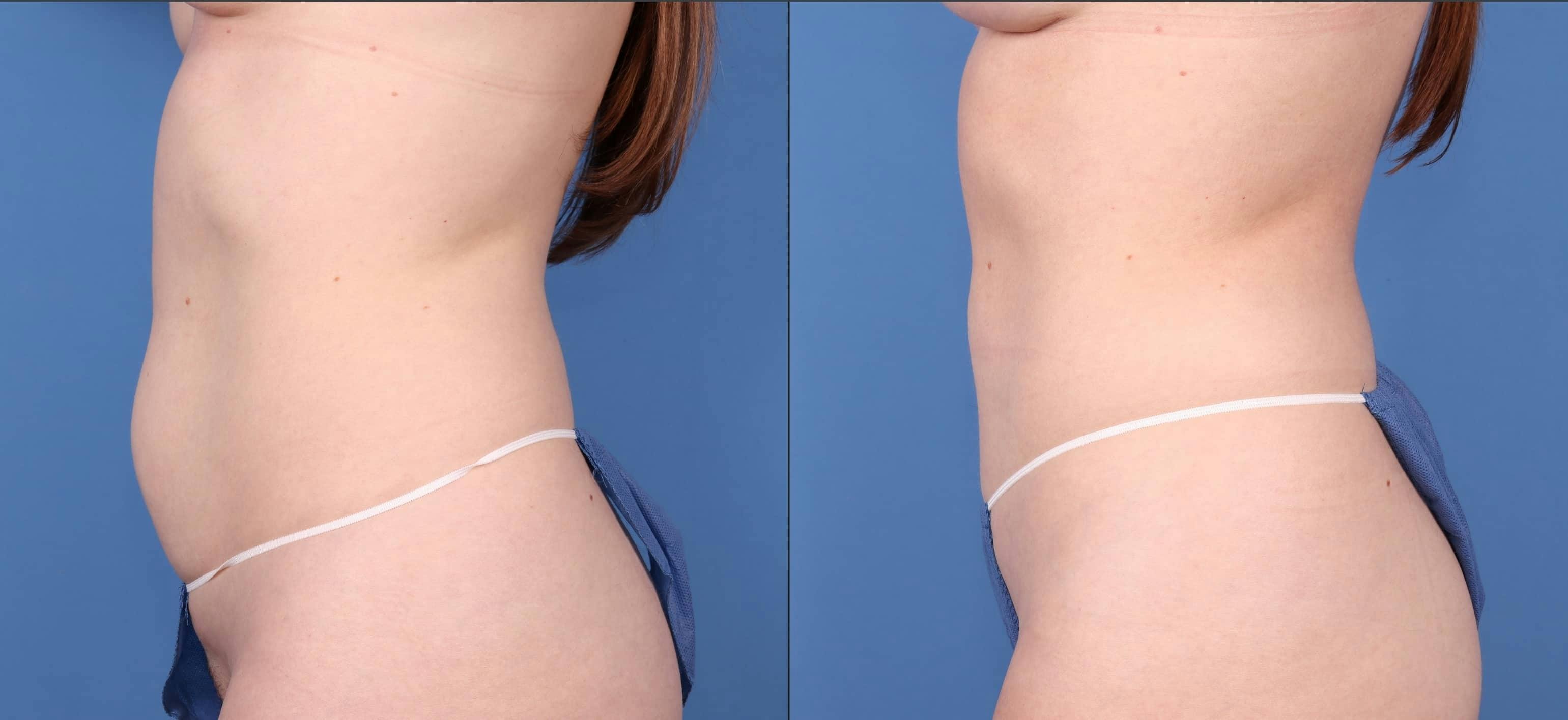 Abdomen Before & After Gallery - Patient 149385211 - Image 3