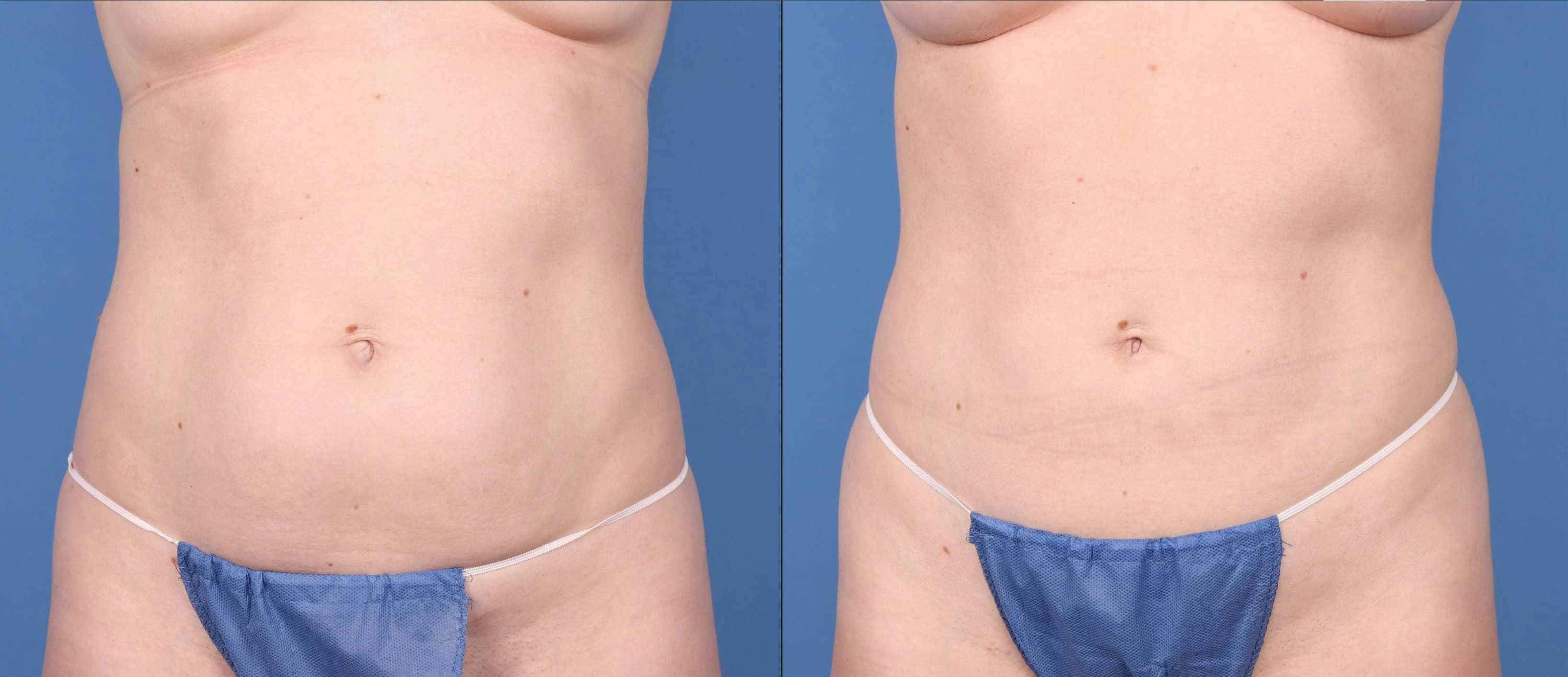 Liposuction Before & After Gallery - Patient 123065064 - Image 1