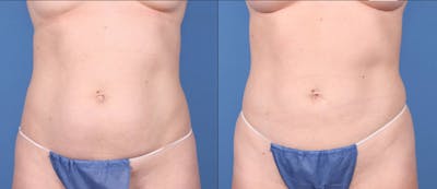 Abdomen Before & After Gallery - Patient 149385211 - Image 1