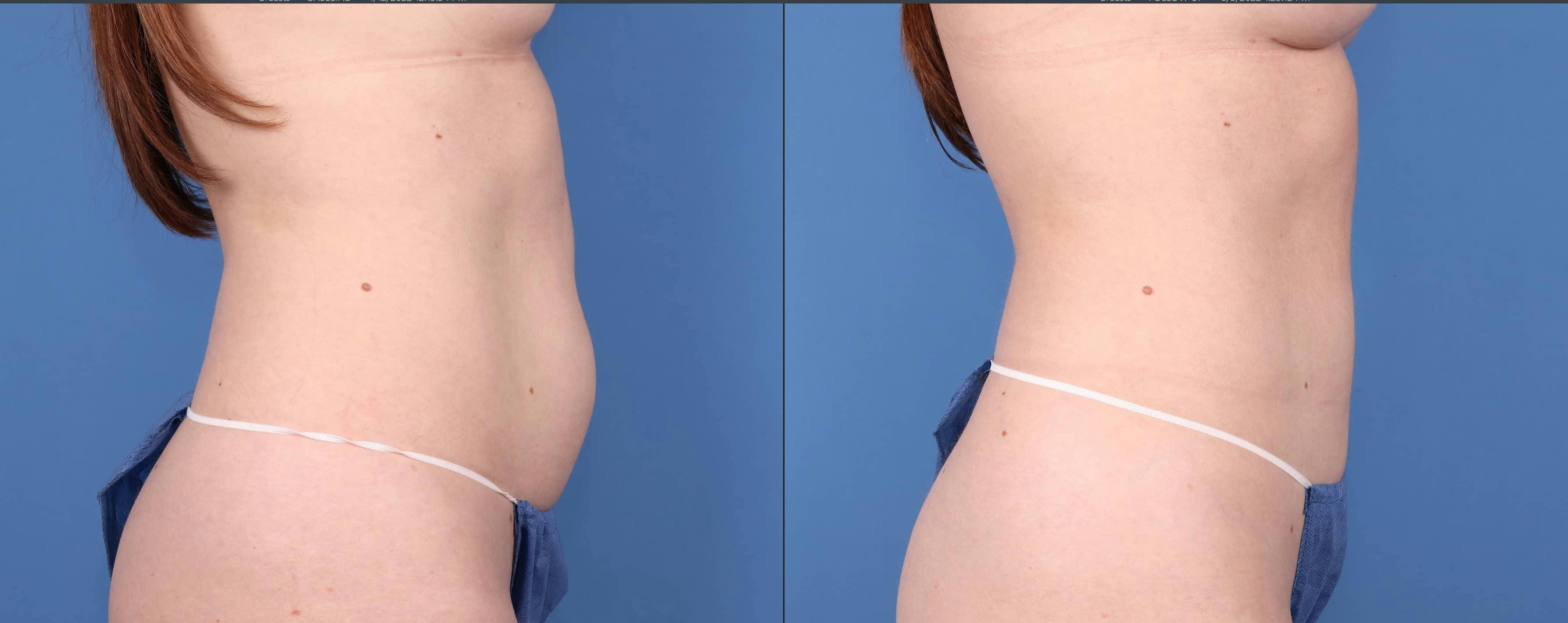 Liposuction Before & After Gallery - Patient 123065064 - Image 4
