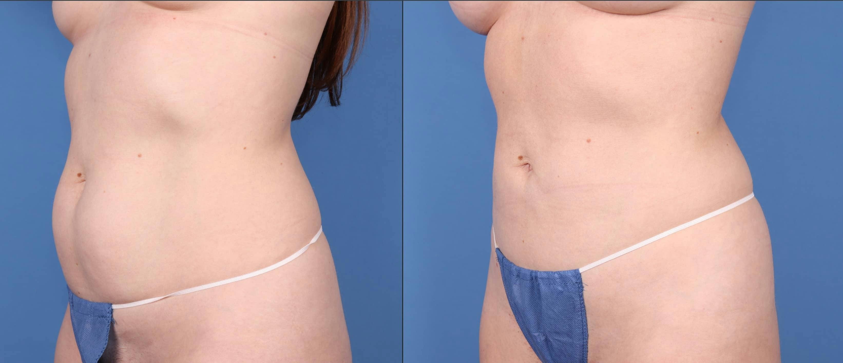Abdomen Before & After Gallery - Patient 149385211 - Image 2