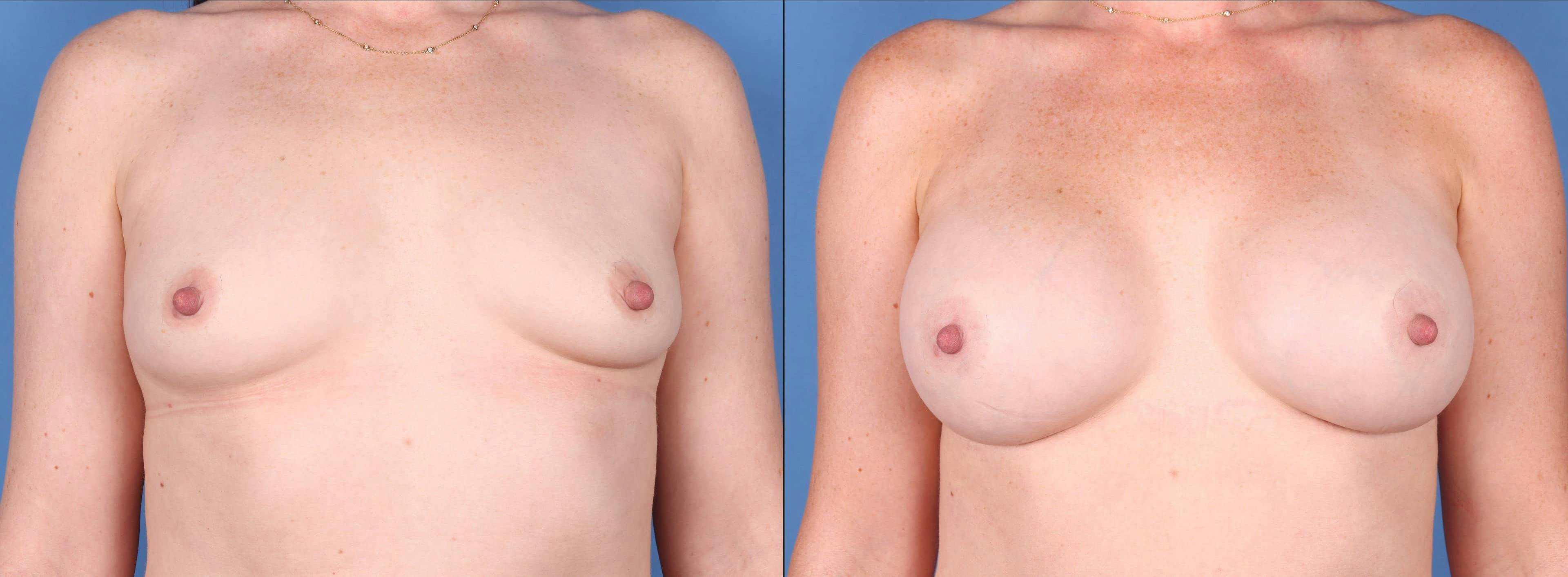 Breast Augmentation Before & After Gallery - Patient 123065075 - Image 1