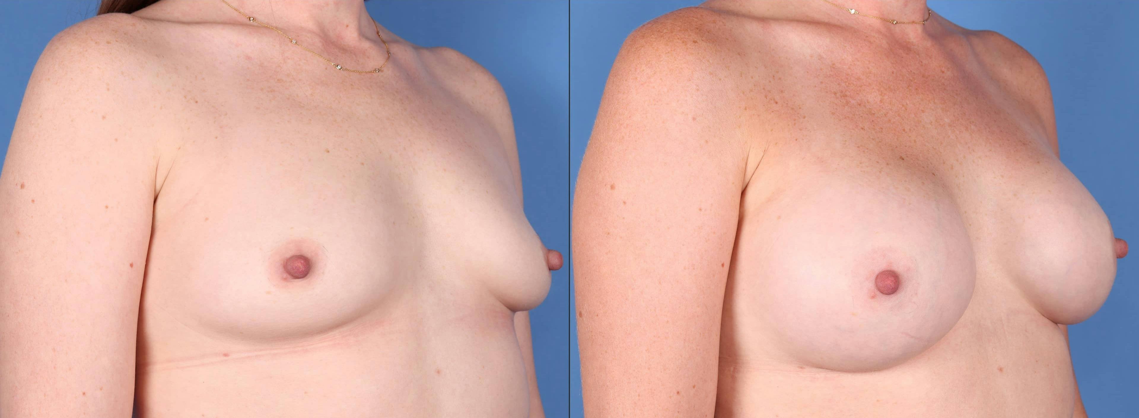 Breast Augmentation Gallery - Patient 123065075 - Image 2