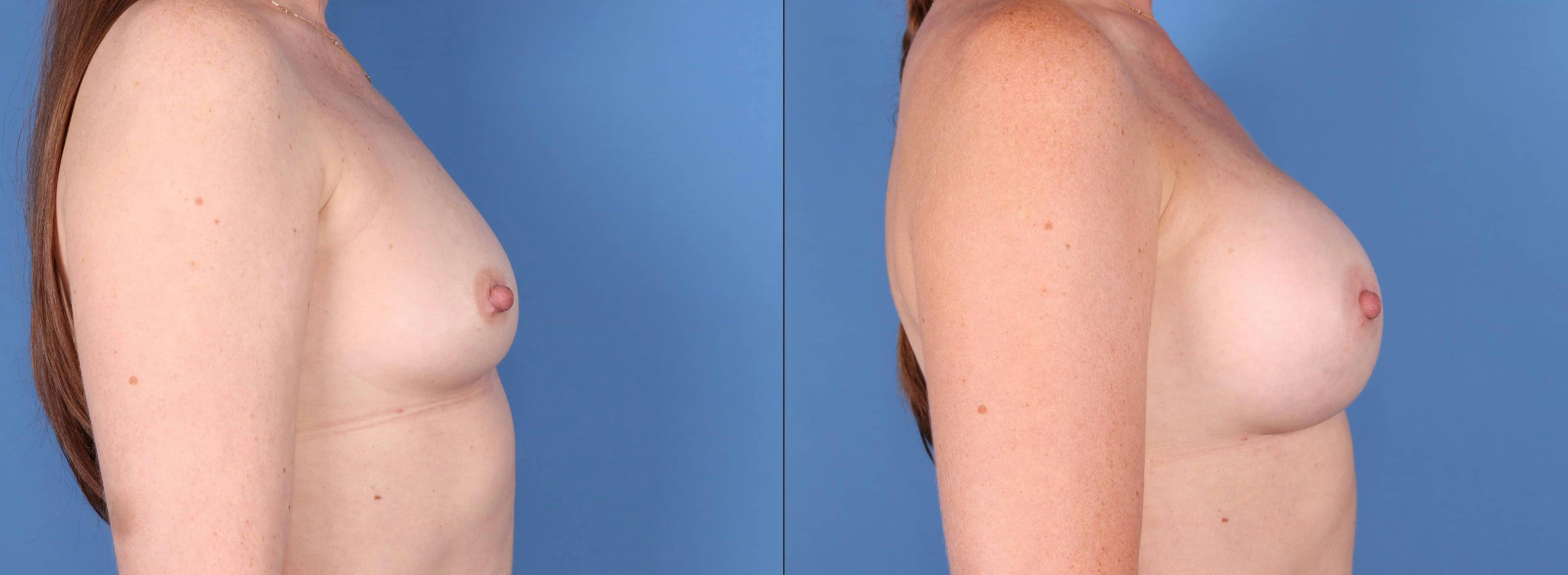 Breast Augmentation Before & After Gallery - Patient 123065075 - Image 3