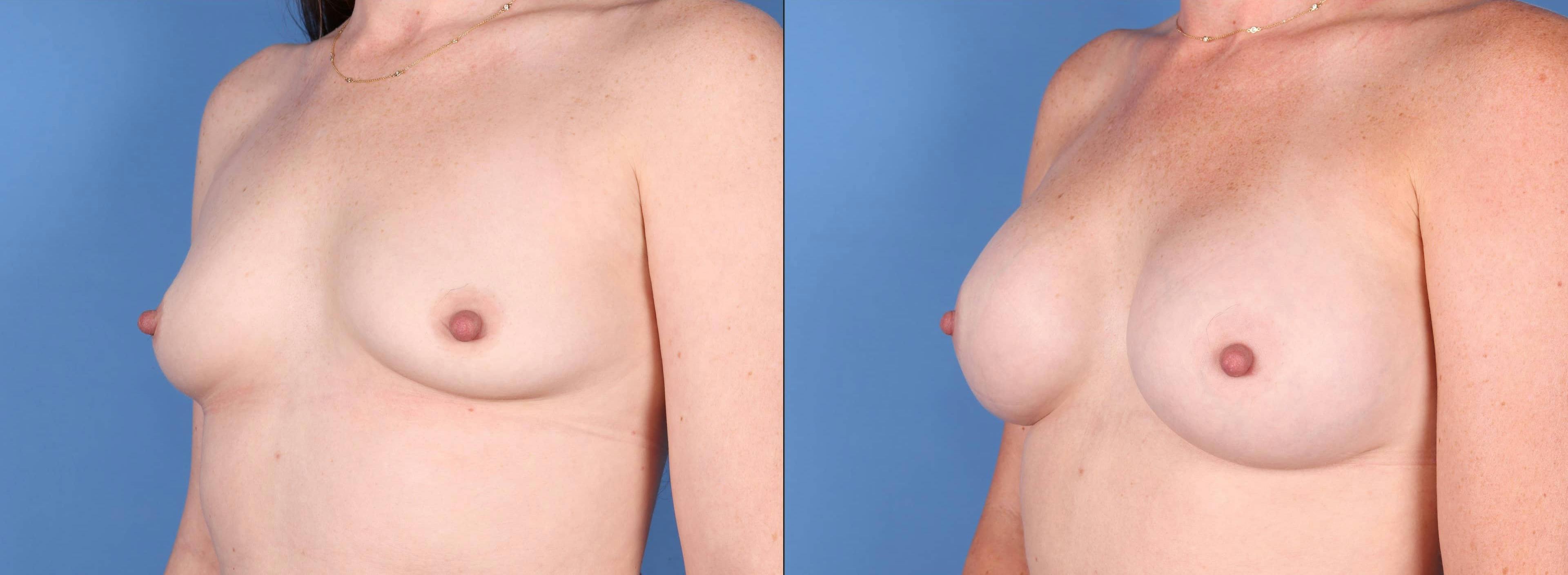 Breast Augmentation Gallery - Patient 123065075 - Image 4