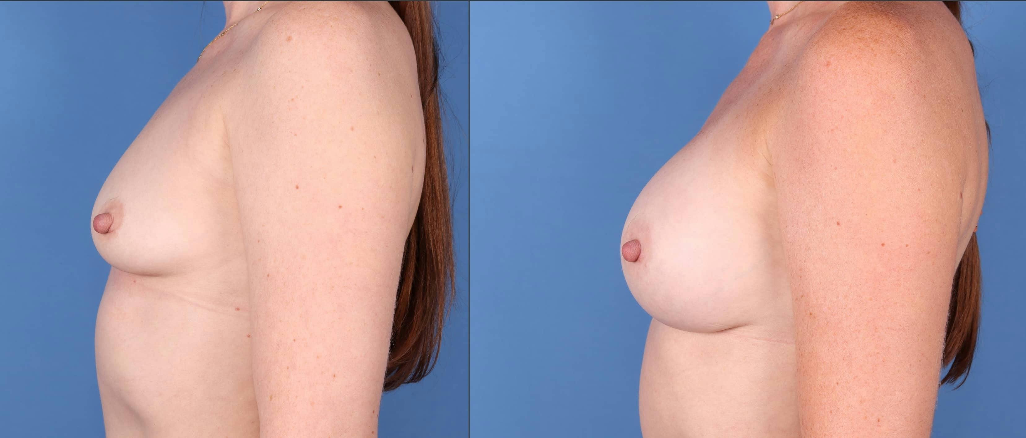 Breast Augmentation Gallery - Patient 123065075 - Image 5