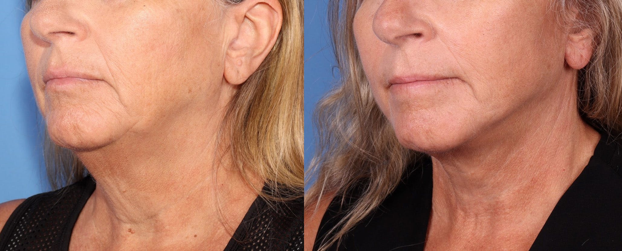 Neck Lift Before & After Gallery - Patient 123696252 - Image 2