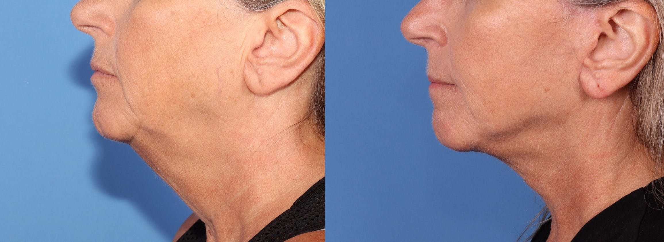 Neck Lift Before & After Gallery - Patient 123696252 - Image 1