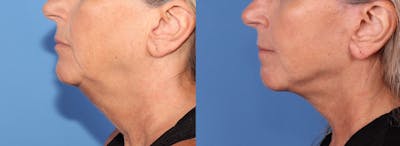 Neck Lift Before & After Gallery - Patient 123696252 - Image 1
