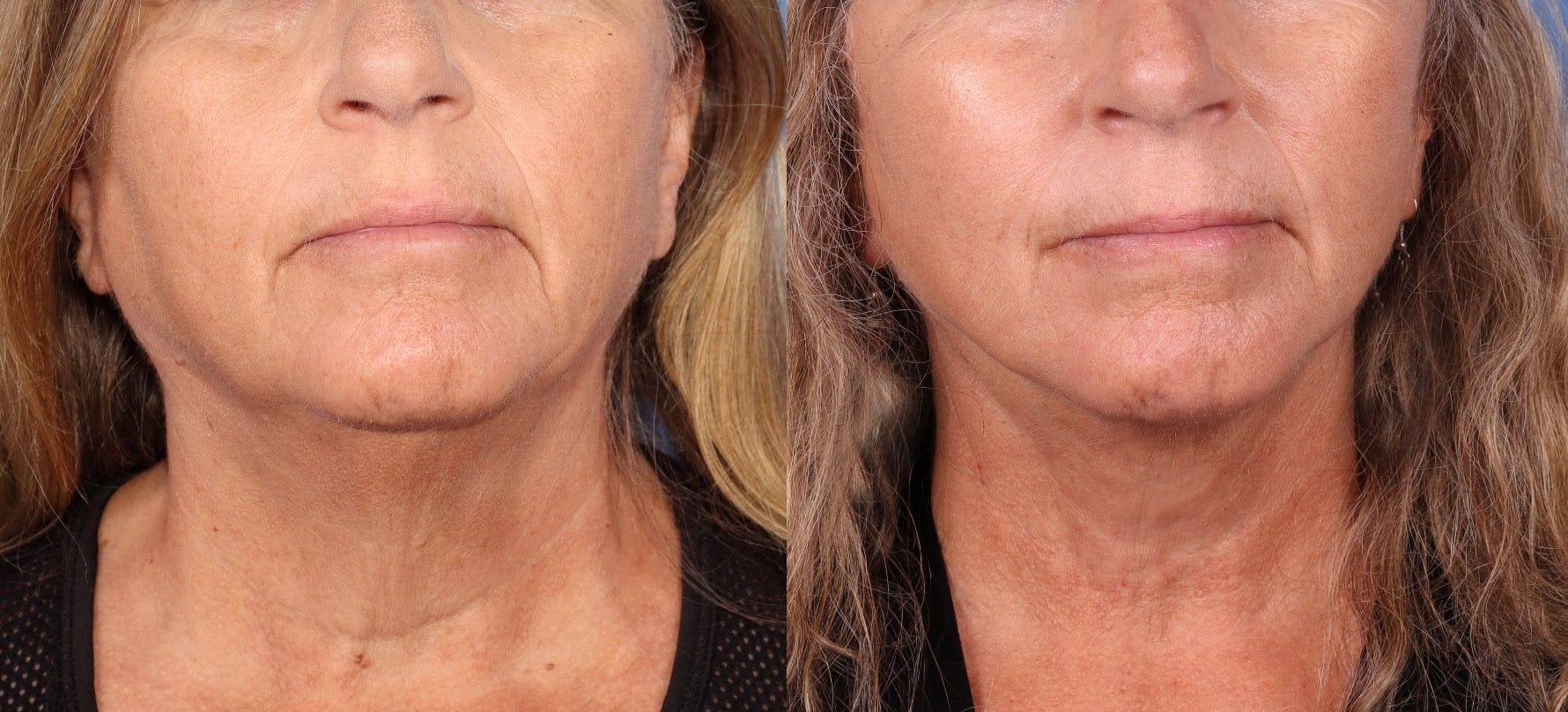 Neck Lift Before & After Gallery - Patient 123696252 - Image 3