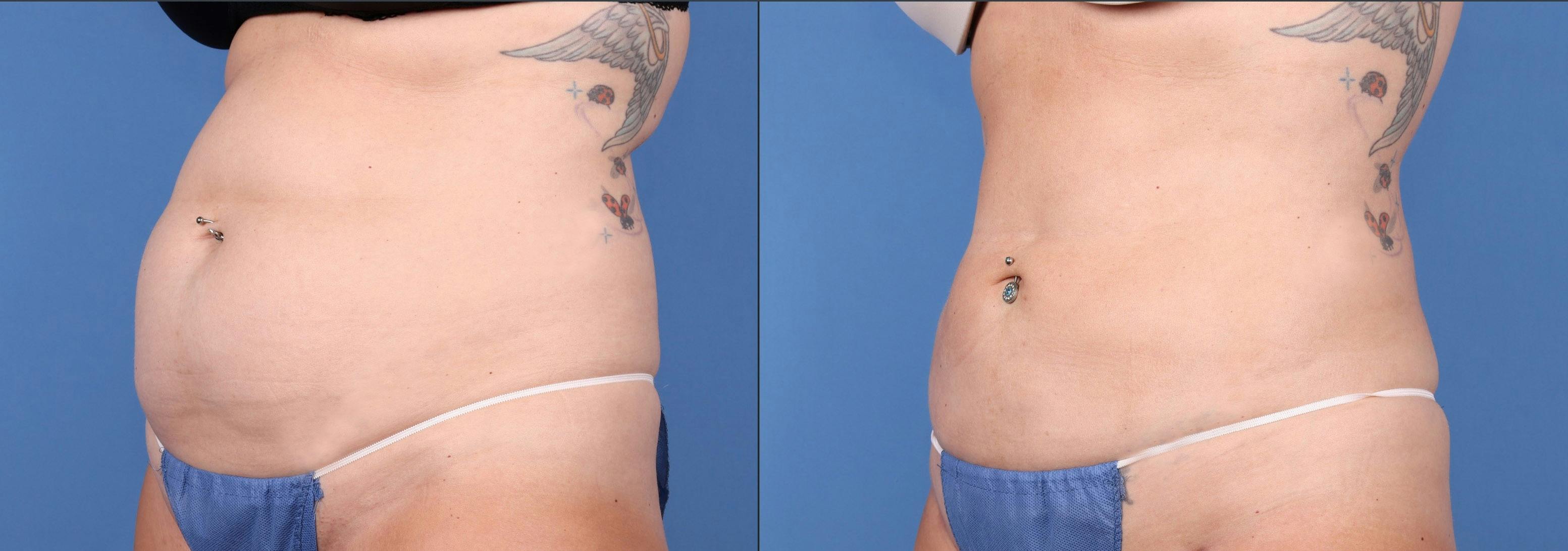 Liposuction Before & After Gallery - Patient 123815483 - Image 1