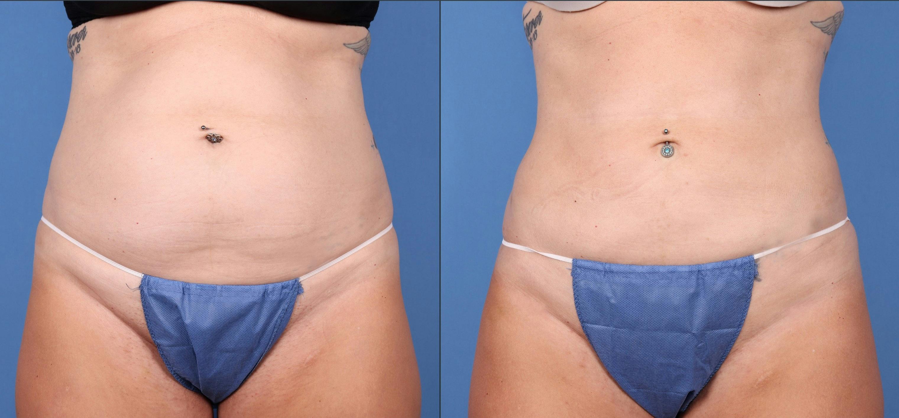 Liposuction Gallery - Patient 123815483 - Image 2