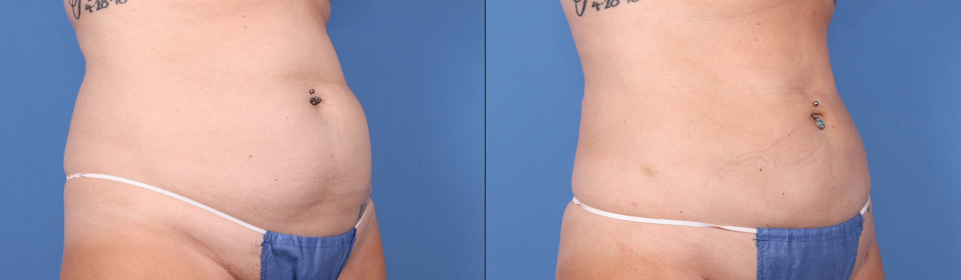 Abdomen Before & After Gallery - Patient 149385210 - Image 3