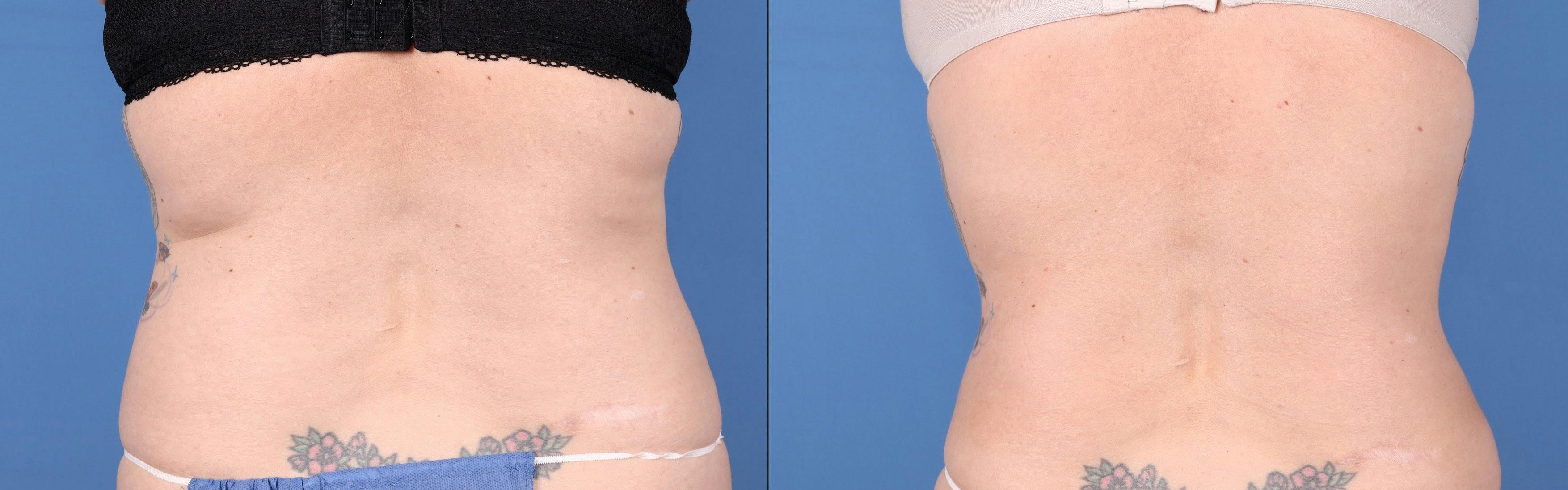 Liposuction Before & After Gallery - Patient 123815483 - Image 4