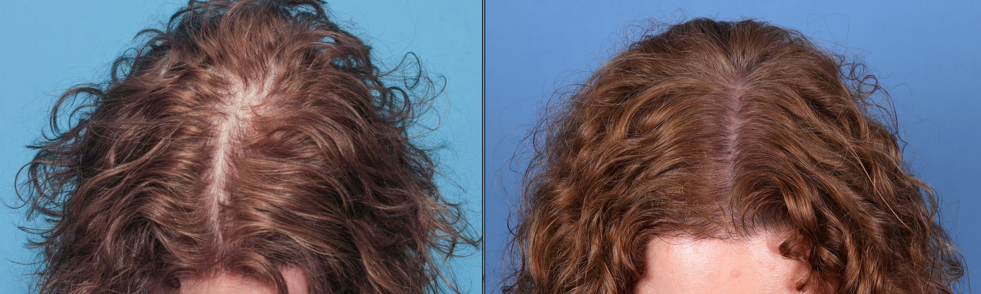 NeoGraft Hair Restoration Before & After Gallery - Patient 131382384 - Image 1