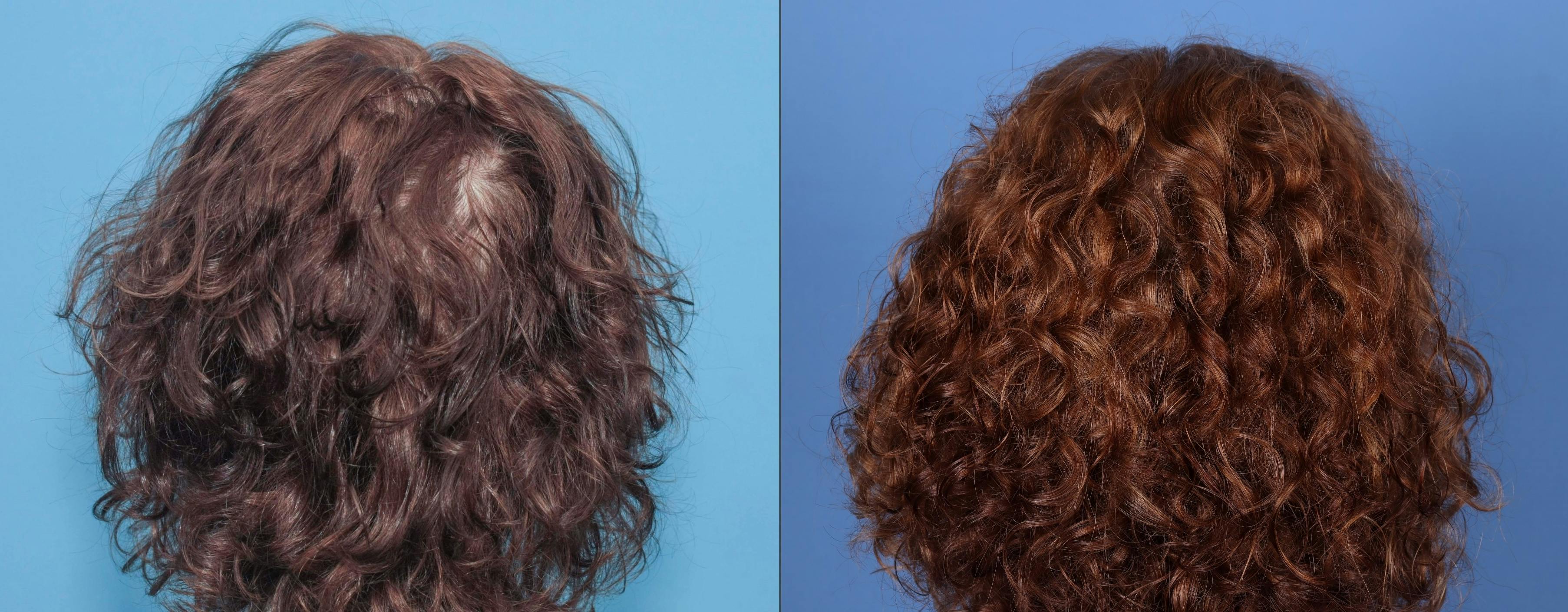 NeoGraft Hair Restoration Before & After Gallery - Patient 131382384 - Image 3