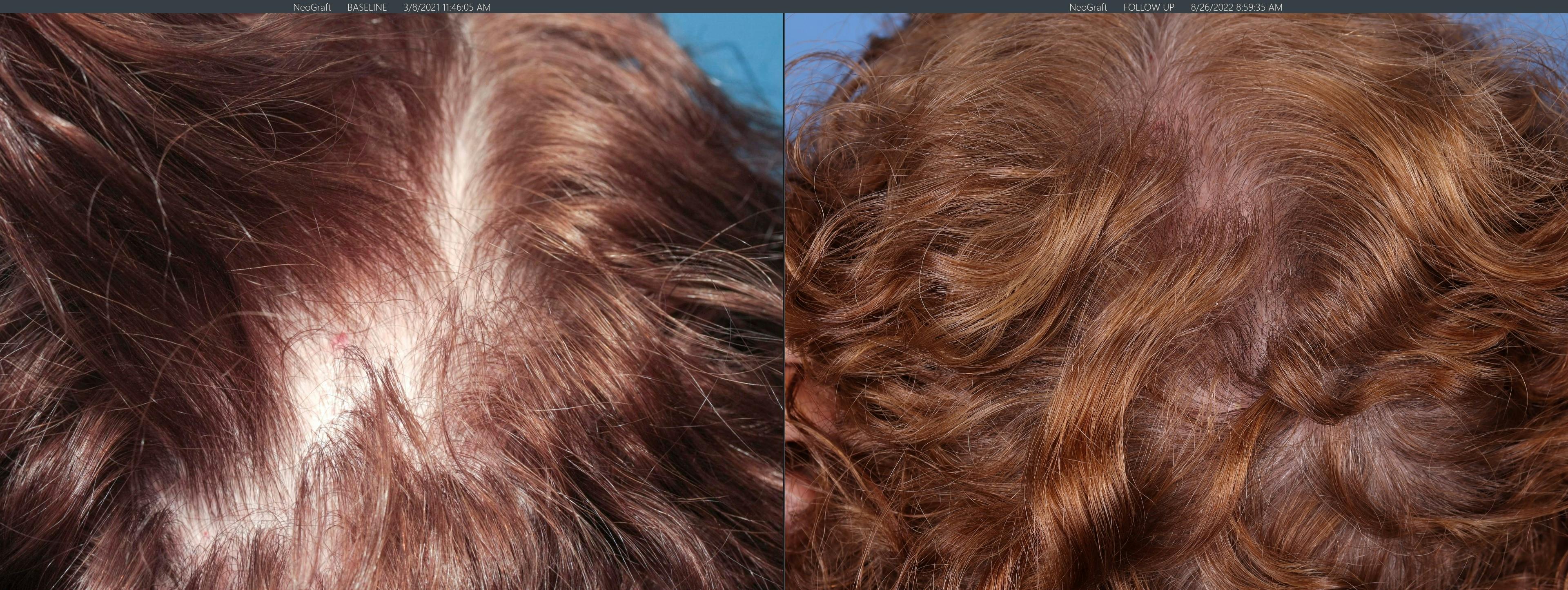 Female Hair Restoration Before & After Gallery - Patient 131385324 - Image 4