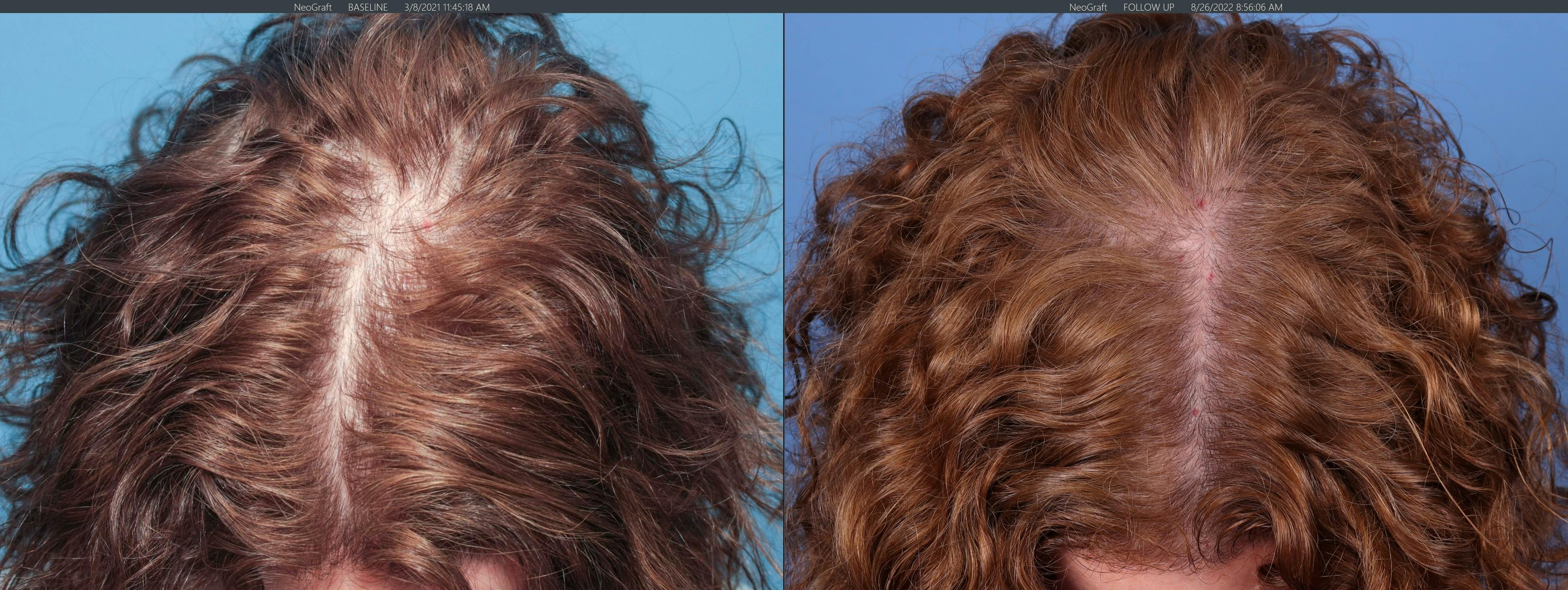 Female Hair Restoration Before & After Gallery - Patient 131385324 - Image 5