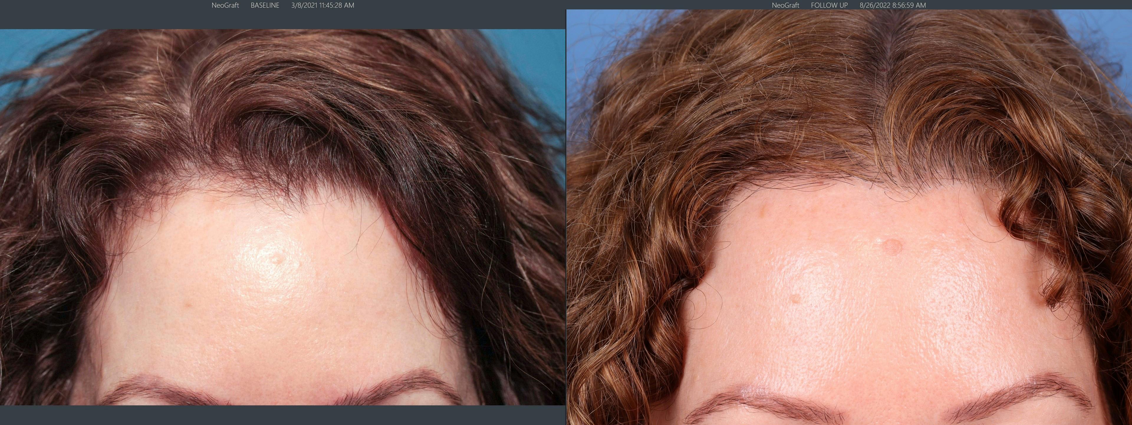 Female Hair Restoration Before & After Gallery - Patient 131385324 - Image 2