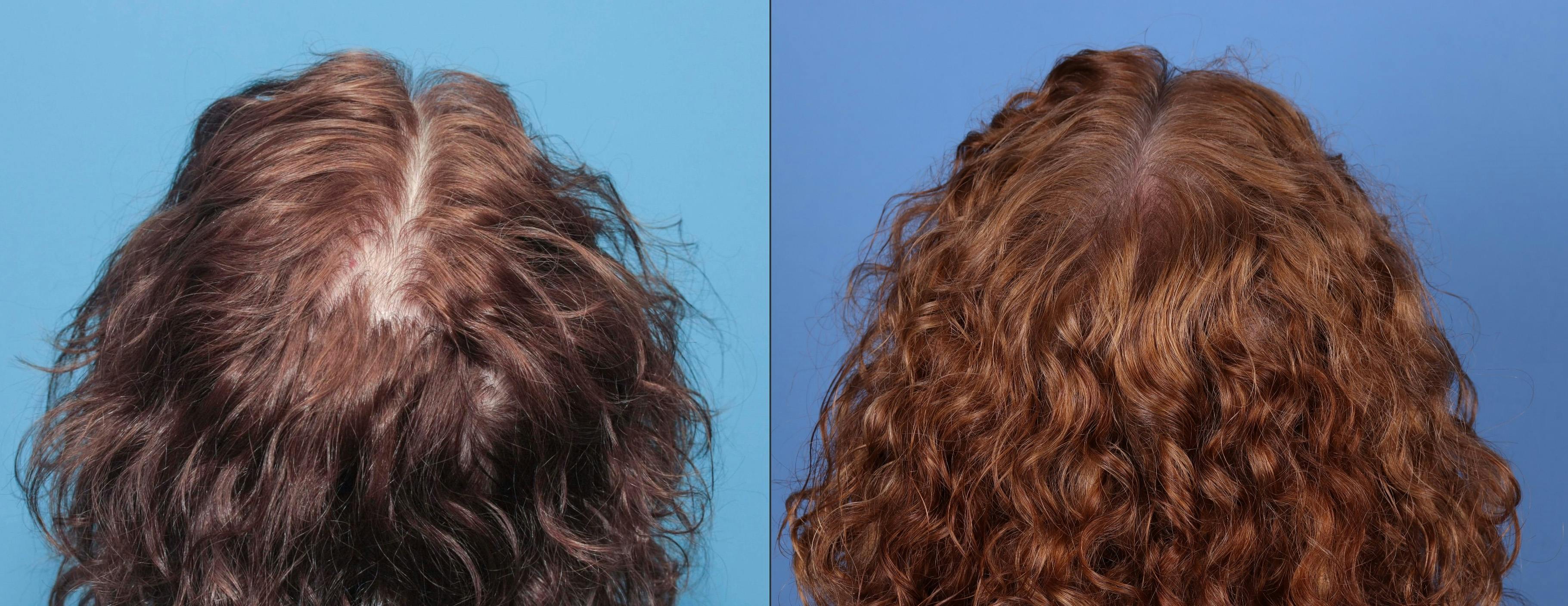 NeoGraft Hair Restoration Before & After Gallery - Patient 131382384 - Image 6