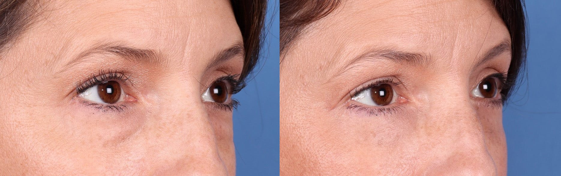 Eyelid Surgery (Lower Blepharoplasty) Before & After Gallery - Patient 340553 - Image 2