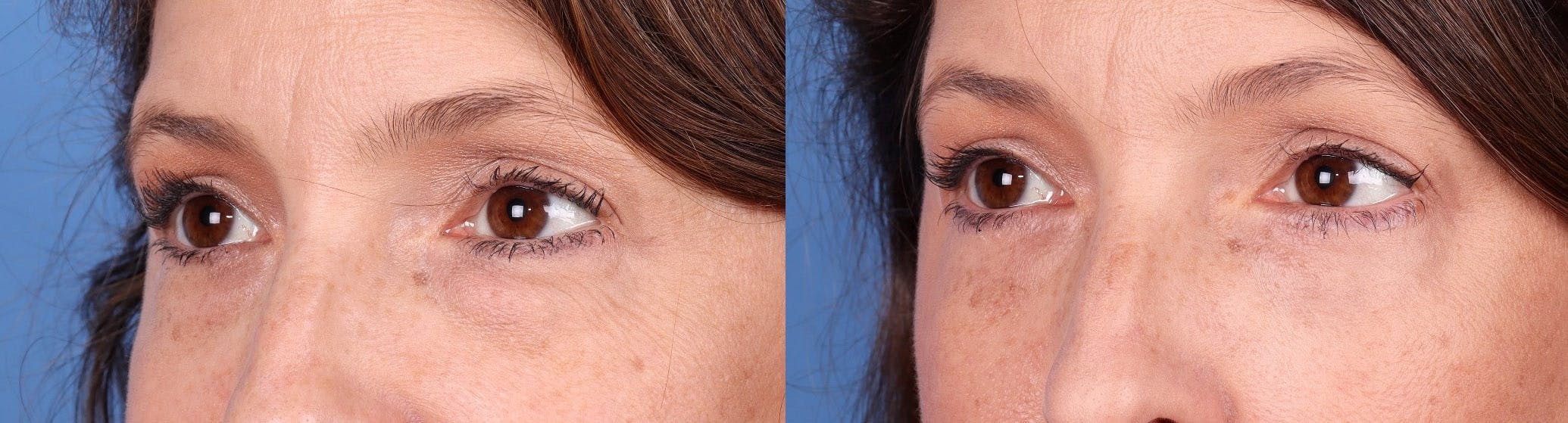 Eyelid Surgery (Blepharoplasty) Before & After Gallery - Patient 131682063 - Image 3