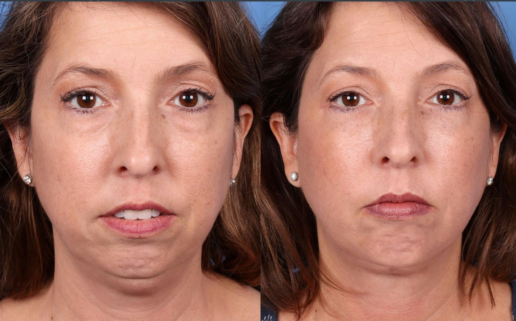 Eyelid Surgery (Blepharoplasty) Before & After Gallery - Patient 131682063 - Image 1