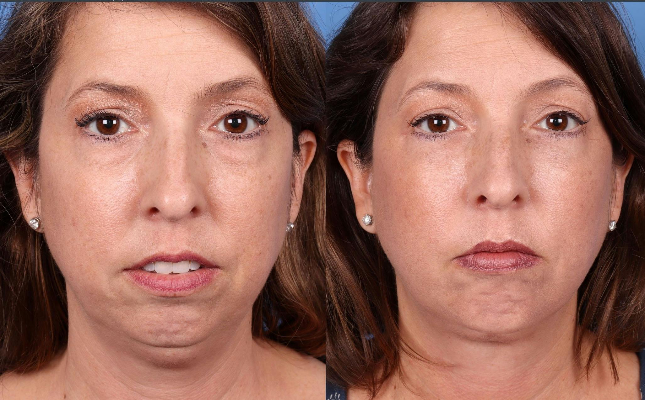 Eyelid Surgery (Lower Blepharoplasty) Before & After Gallery - Patient 340553 - Image 1