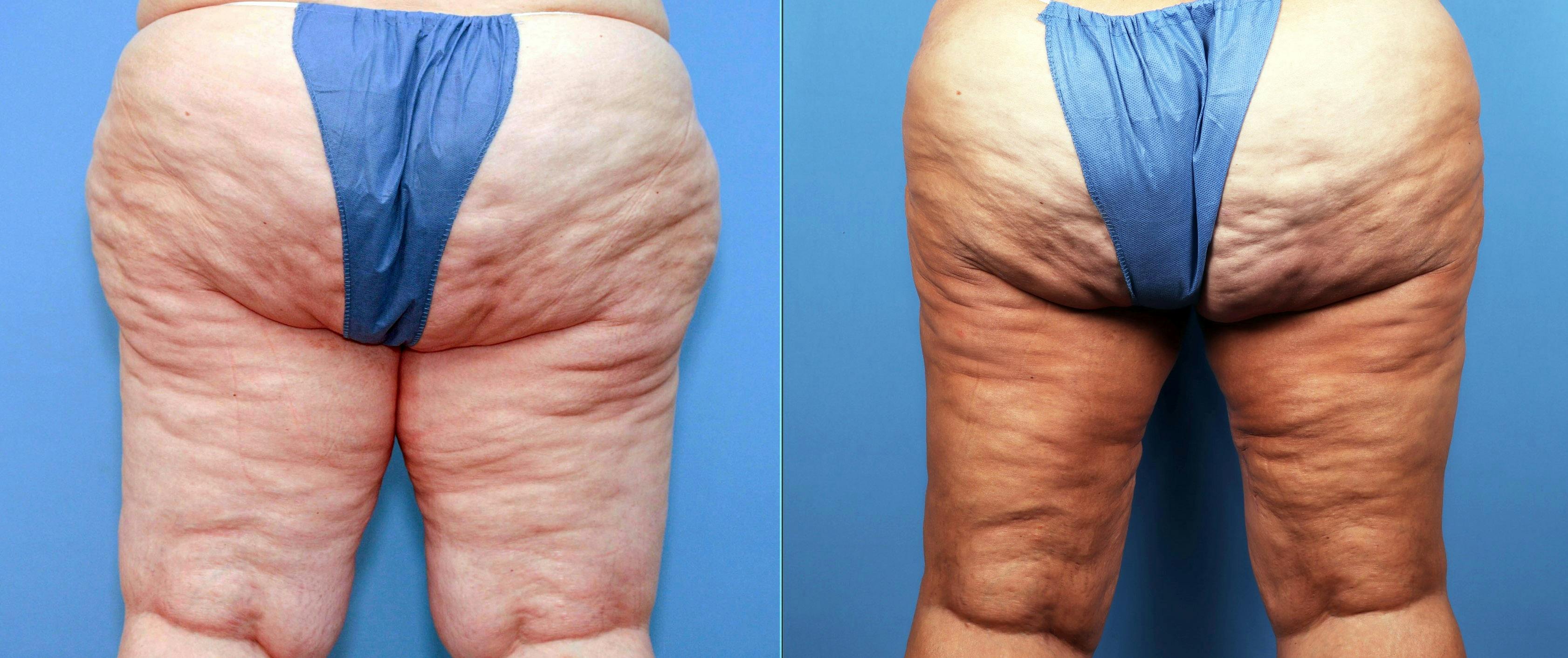 Thigh Lift Before & After Gallery - Patient 132874168 - Image 3