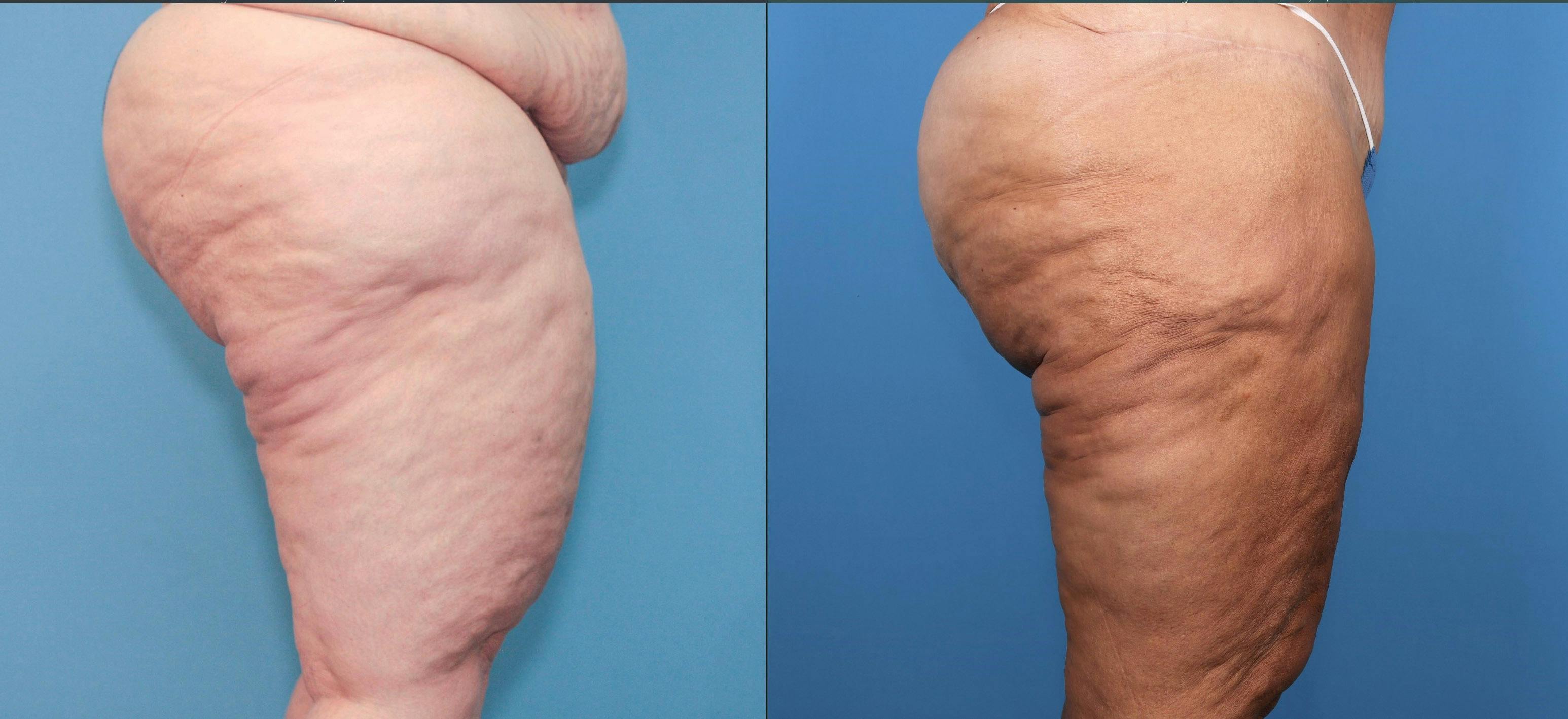 Thigh Lift Before & After Gallery - Patient 132874168 - Image 2