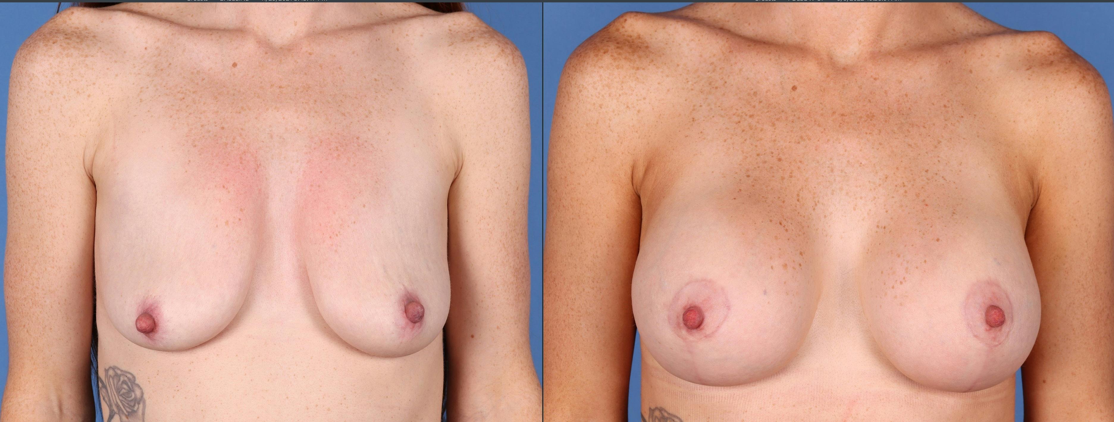 Breast Lift with Augmentation Before & After Gallery - Patient 141066593 - Image 4