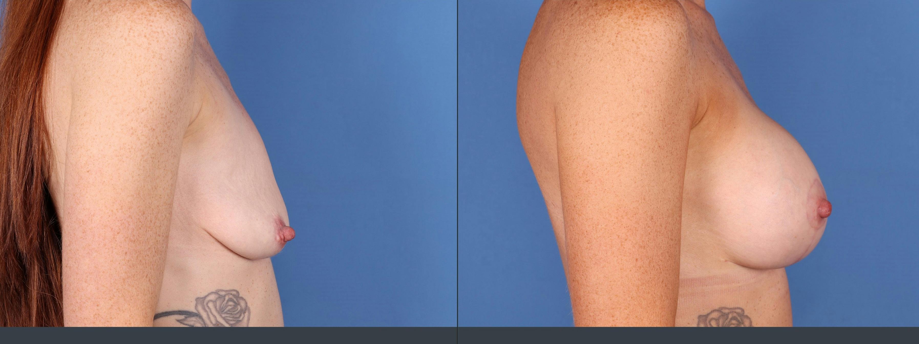 Breast Lift with Augmentation Before & After Gallery - Patient 141066593 - Image 2