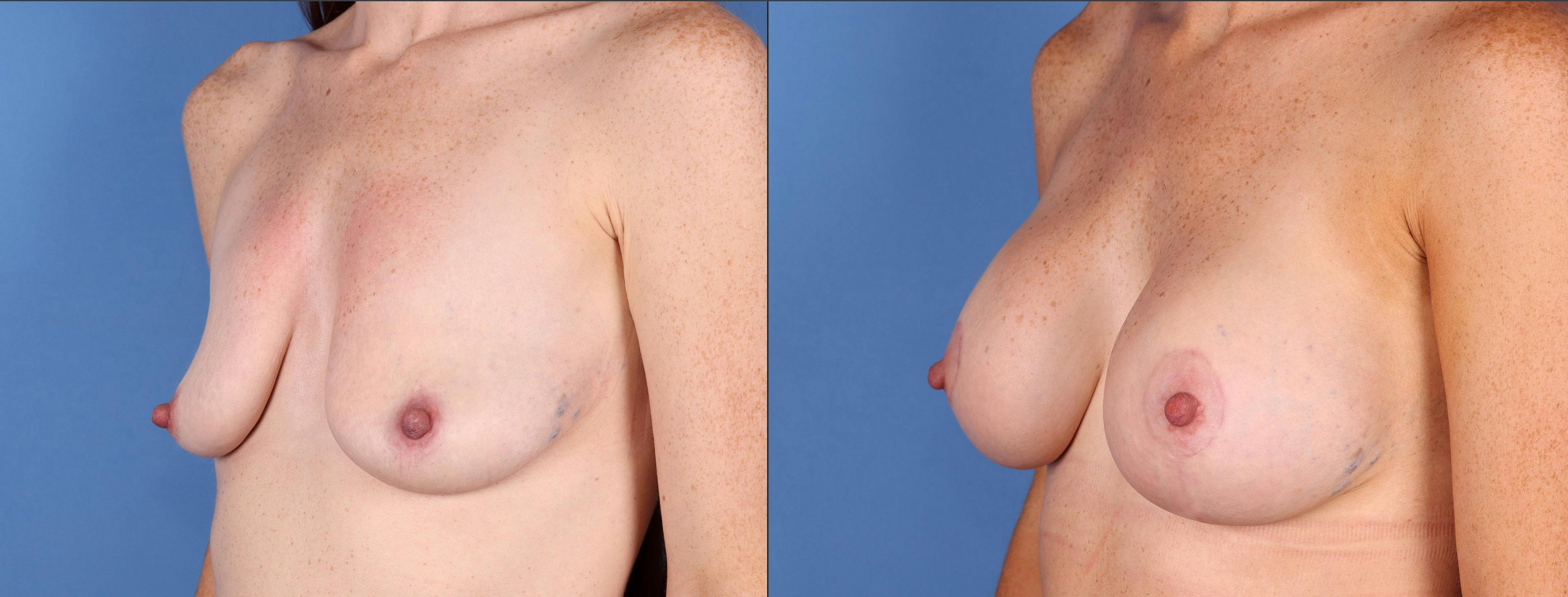 Breast Lift with Augmentation Before & After Gallery - Patient 141066593 - Image 1