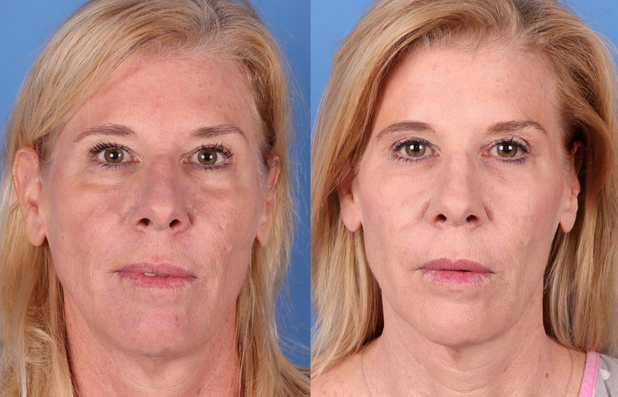 Eyelid Surgery (Blepharoplasty) Before & After Gallery - Patient 141137476 - Image 1