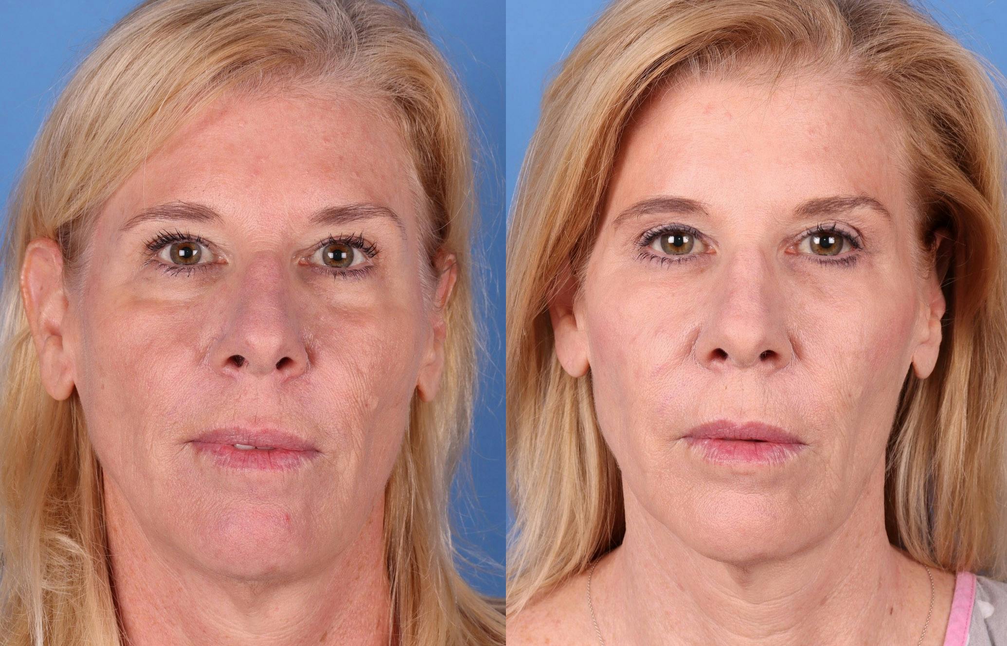 Eyelid Surgery (Lower Blepharoplasty) Before & After Gallery - Patient 303812 - Image 1