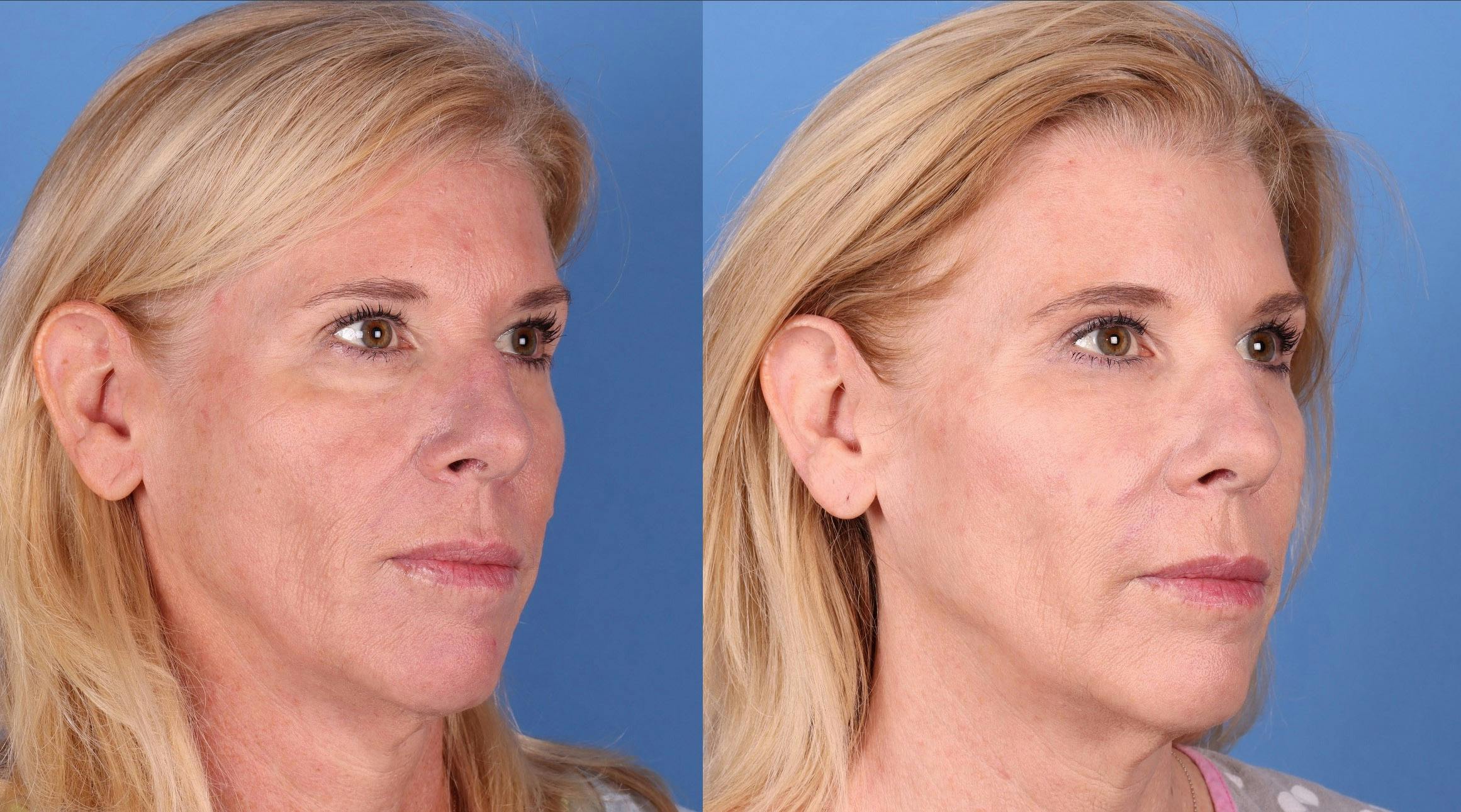 Eyelid Surgery (Blepharoplasty) Before & After Gallery - Patient 141137476 - Image 2