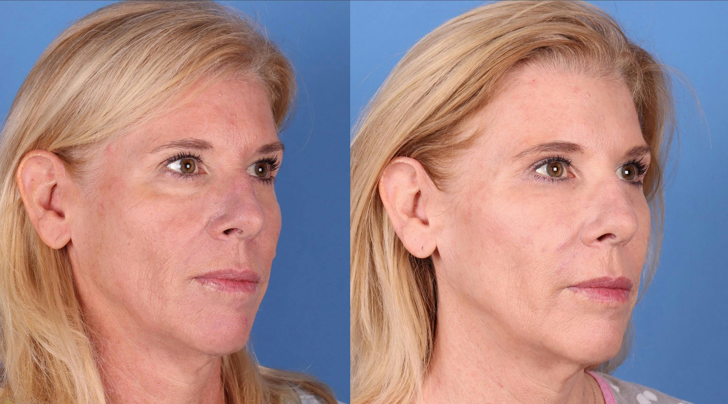 Eyelid Surgery (Lower Blepharoplasty) Before & After Gallery - Patient 303812 - Image 2