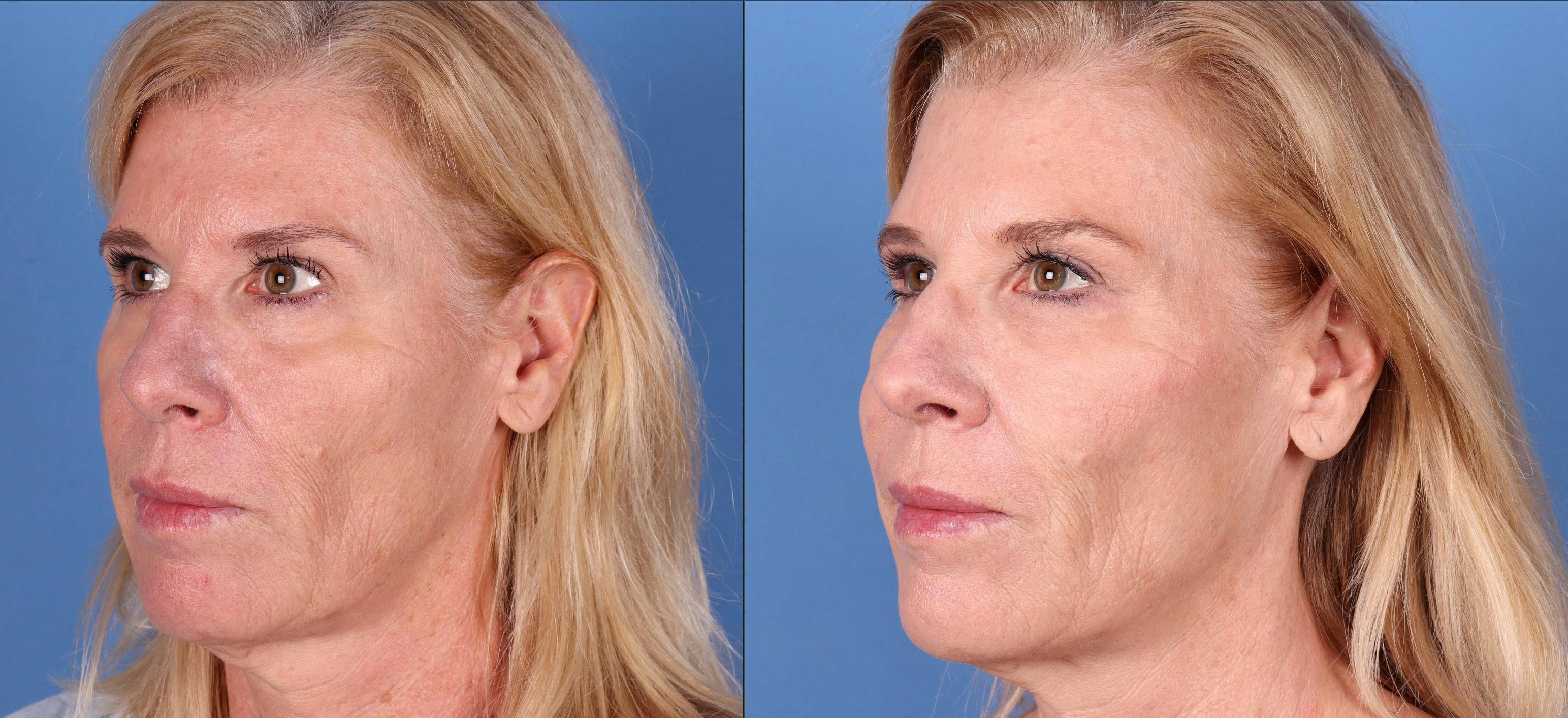 Eyelid Surgery (Lower Blepharoplasty) Before & After Gallery - Patient 303812 - Image 3