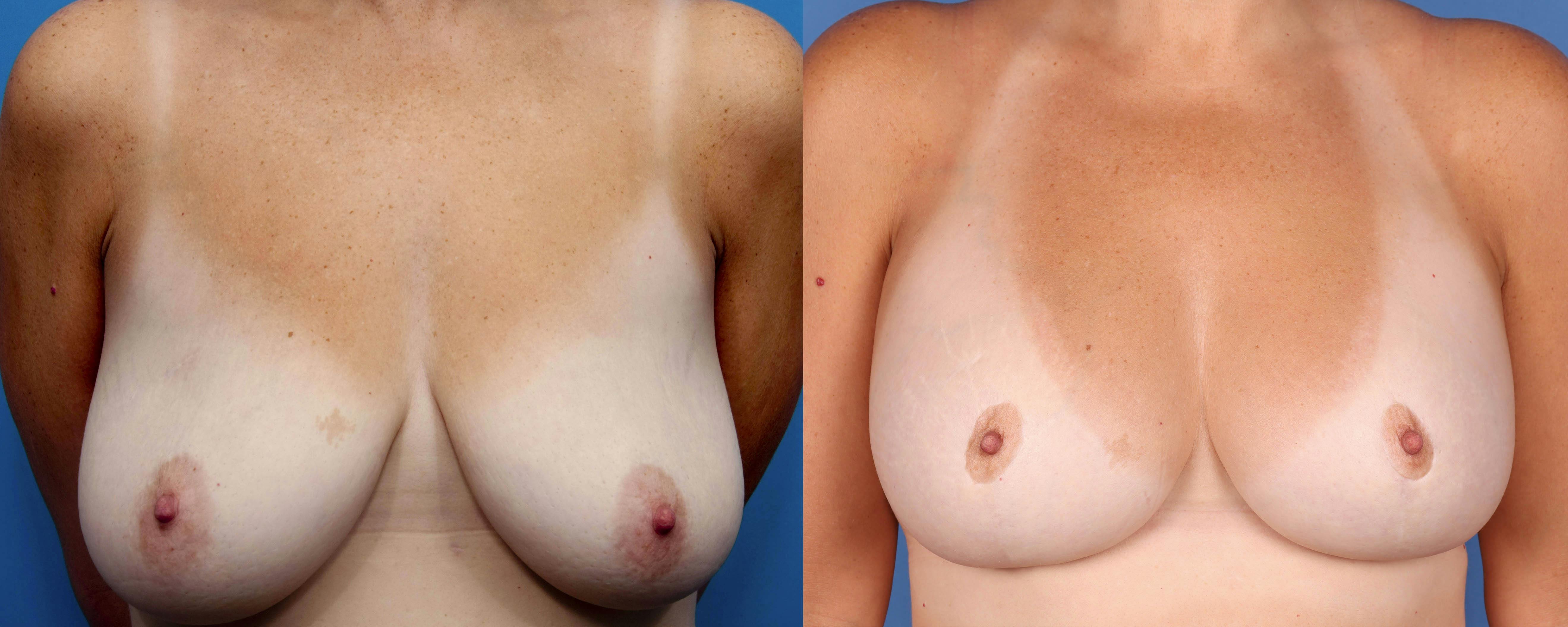 Breast Lift with Augmentation Before & After Gallery - Patient 141201823 - Image 1