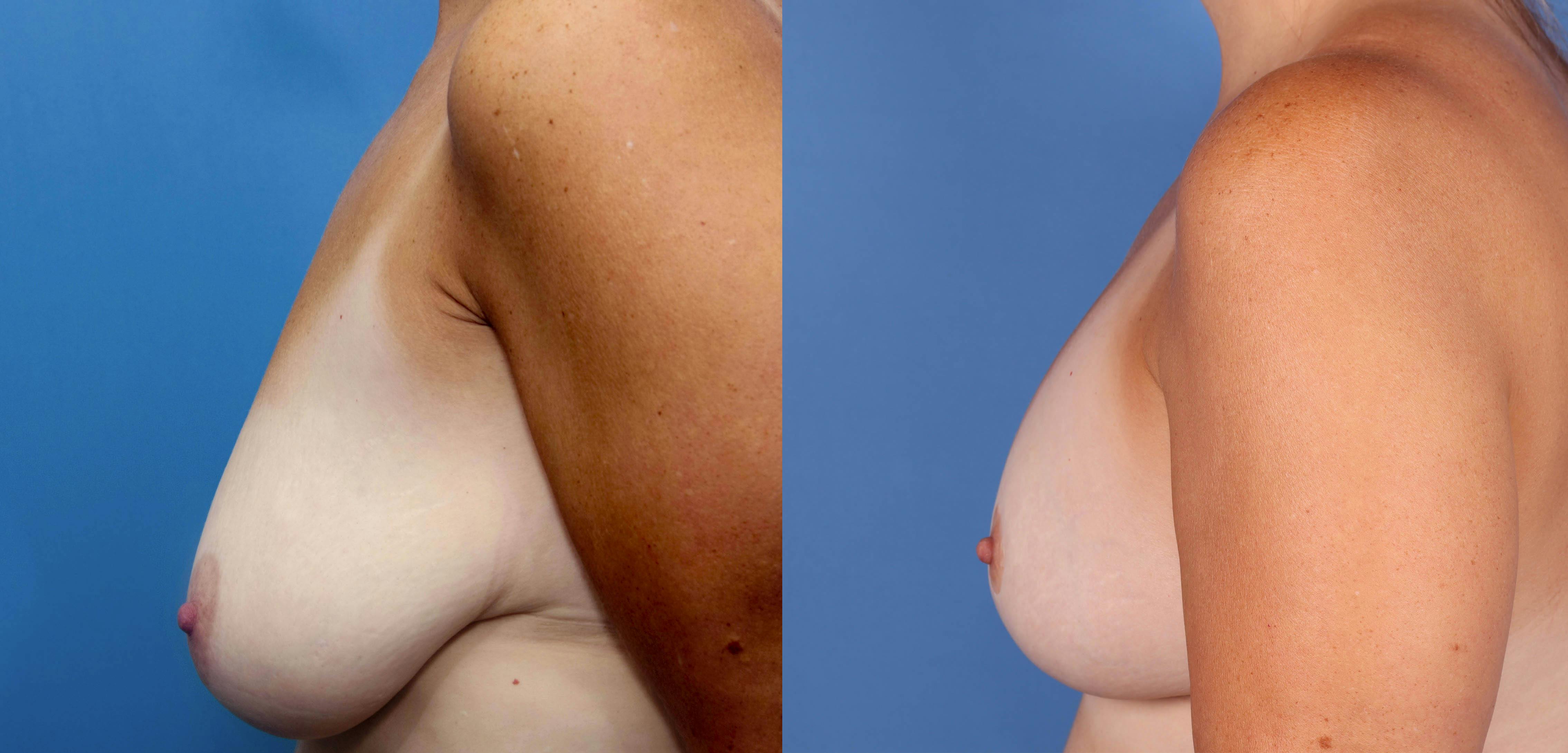 Breast Lift with Augmentation Gallery - Patient 141201823 - Image 5