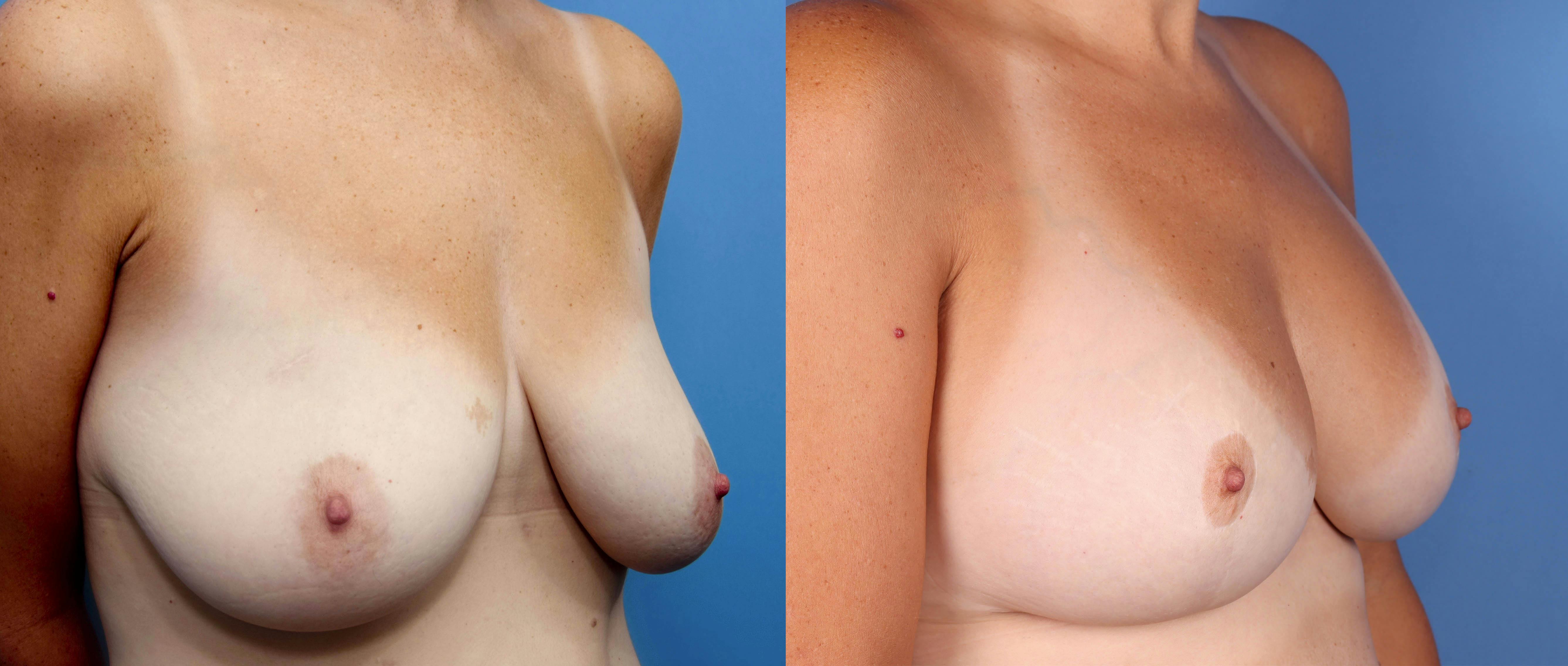 Breast Lift with Augmentation Before & After Gallery - Patient 141201823 - Image 2