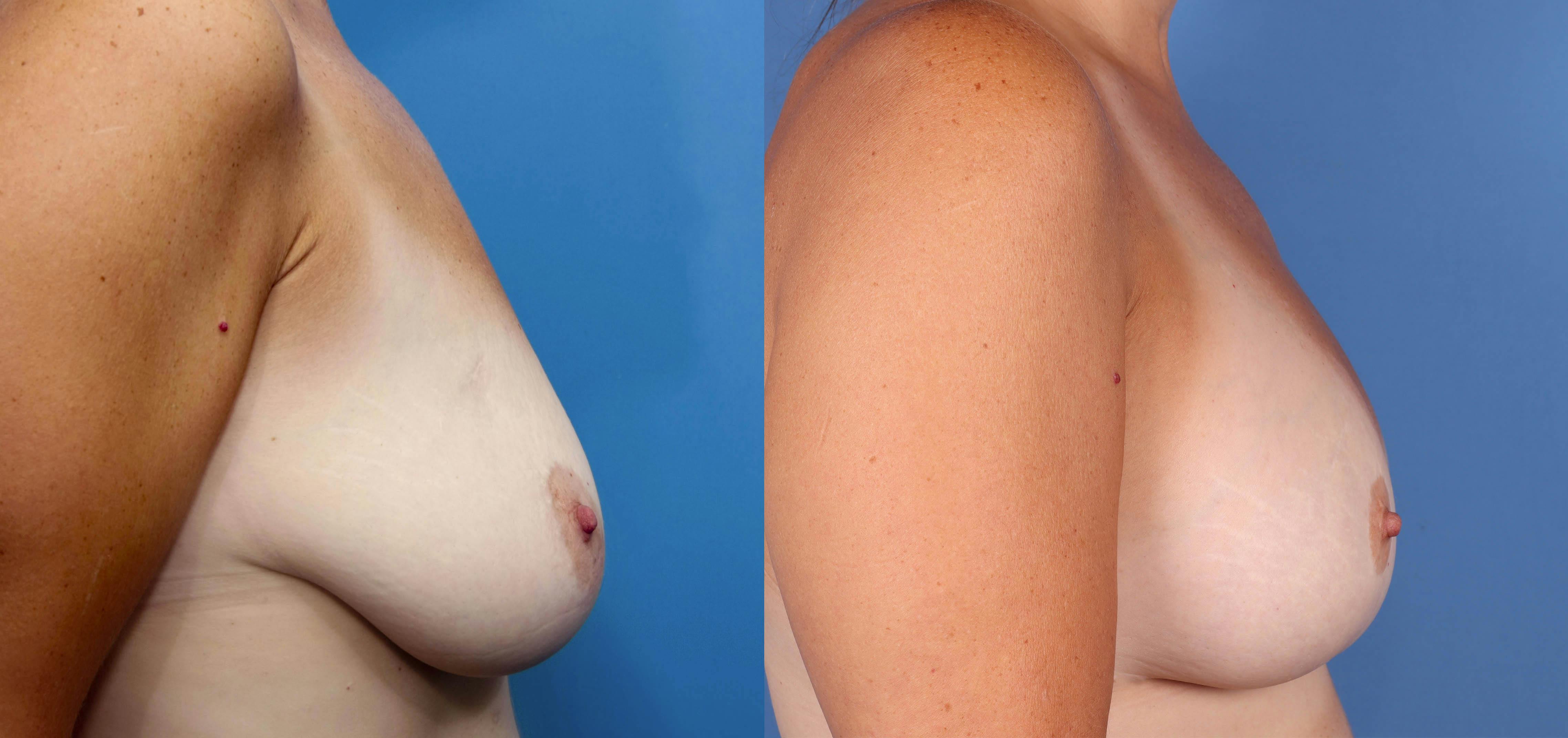 Breast Lift with Augmentation Before & After Gallery - Patient 141201823 - Image 3