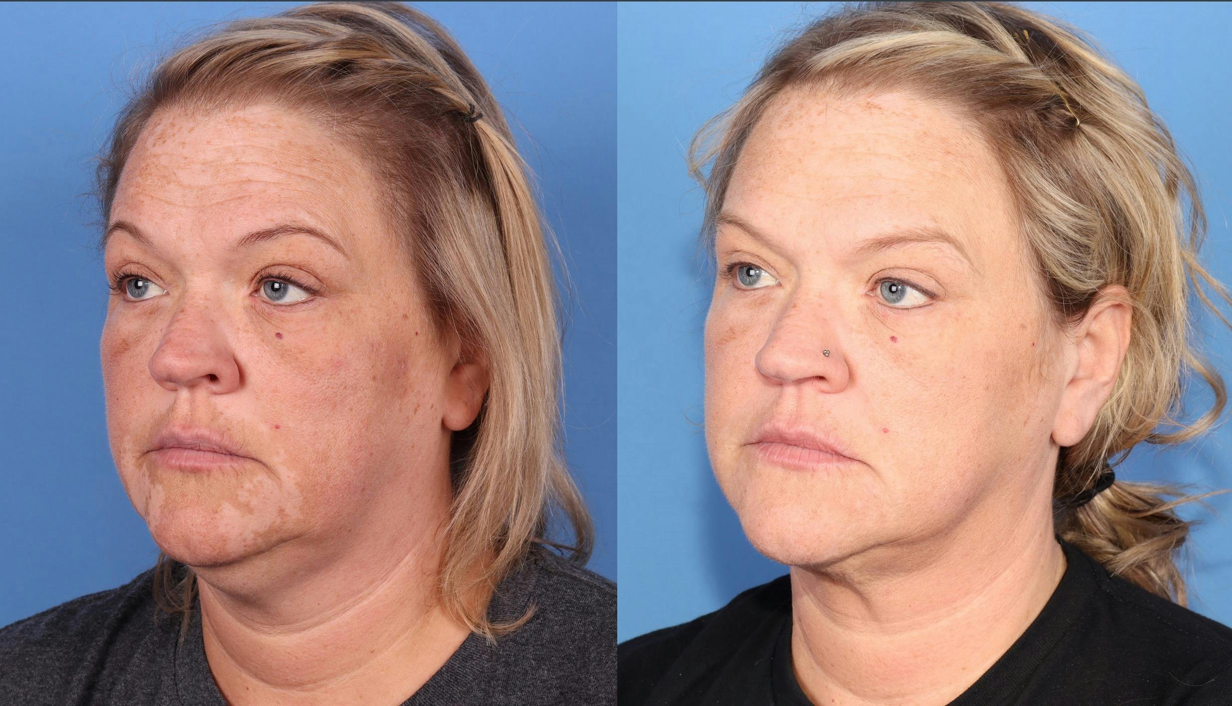 Face & Neck Before & After Gallery - Patient 149385109 - Image 2