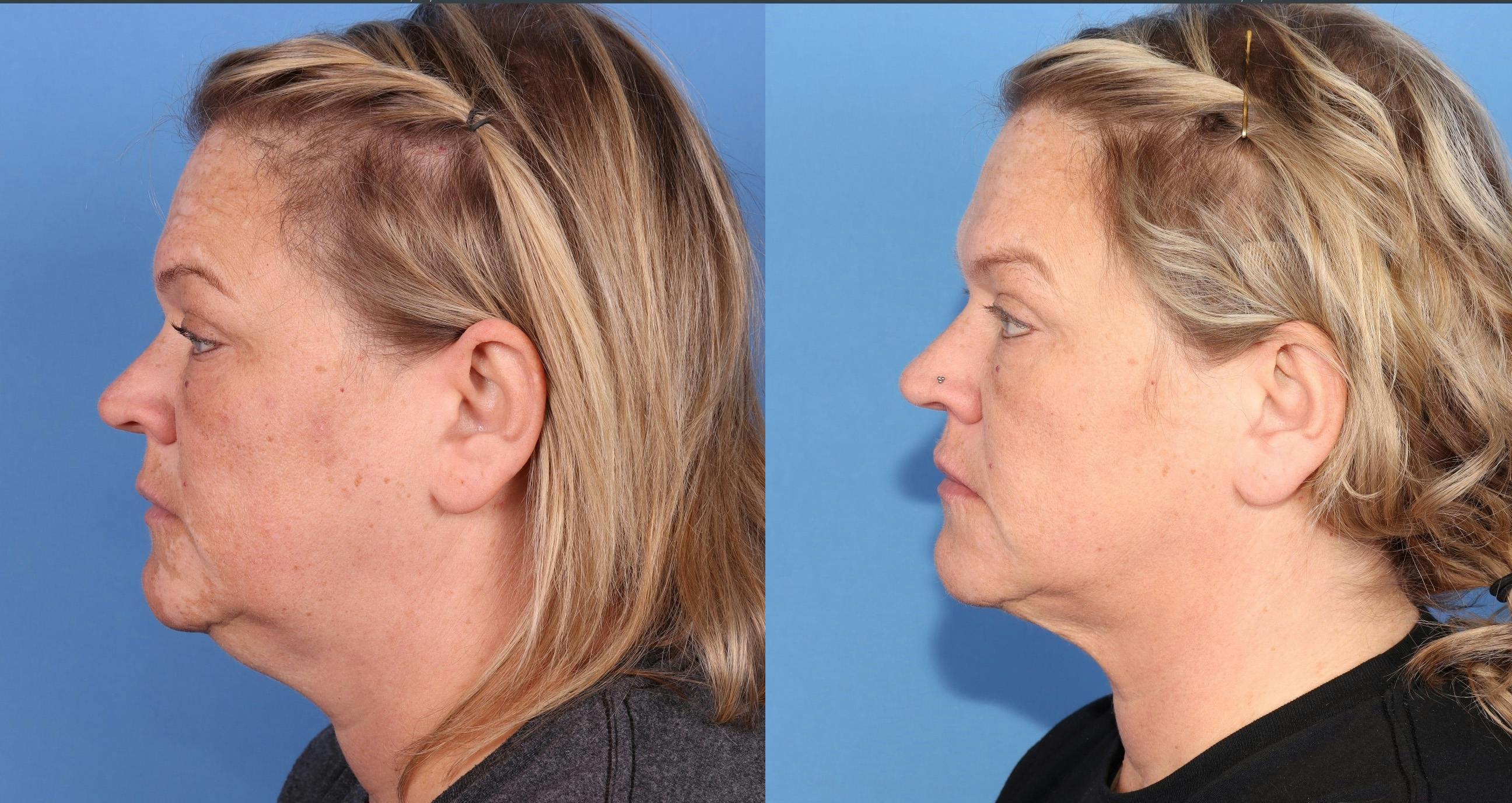 Face & Neck Before & After Gallery - Patient 149385109 - Image 3